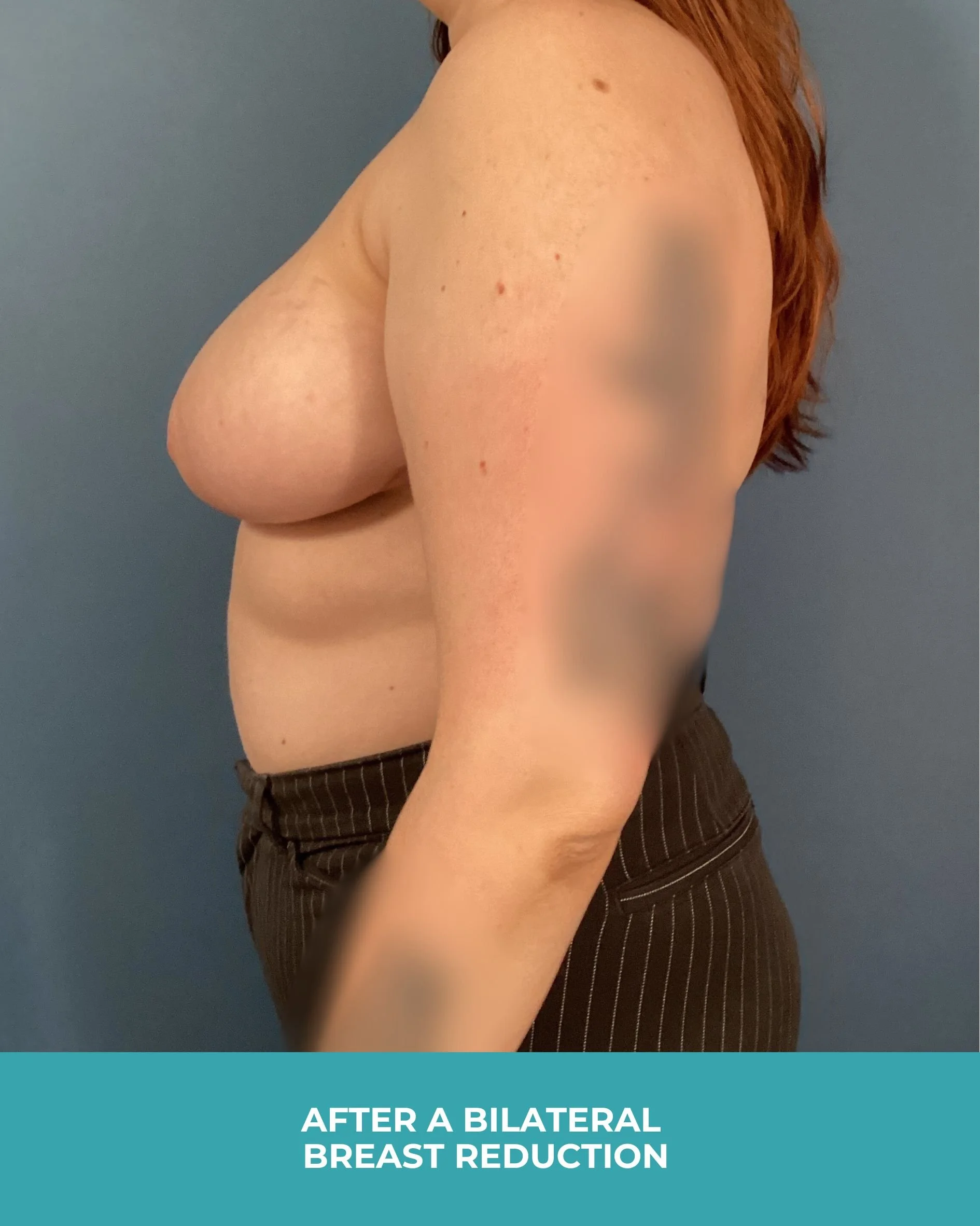 B&A Bilateral breast reduction (4).jpg