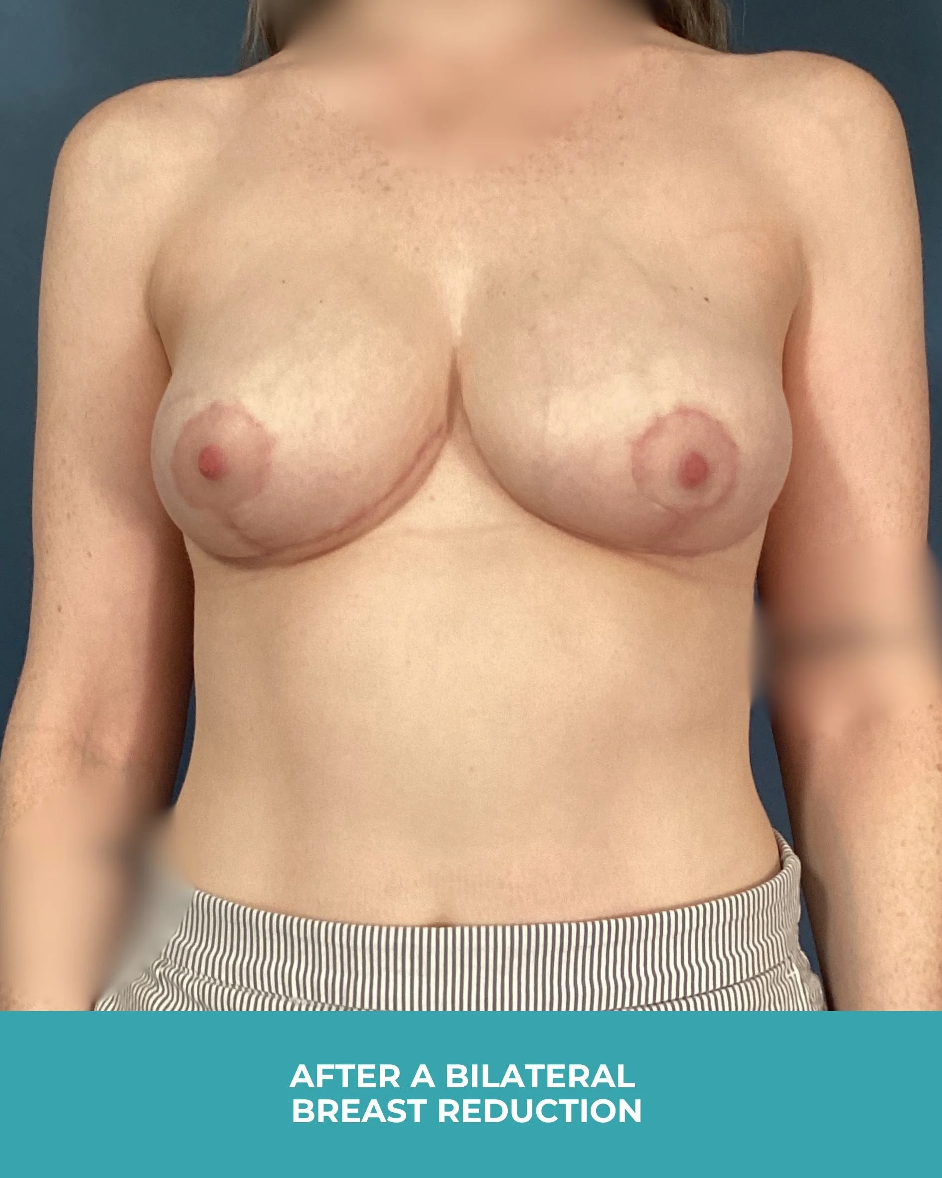 B&A Bilateral breast reduction (2).jpg