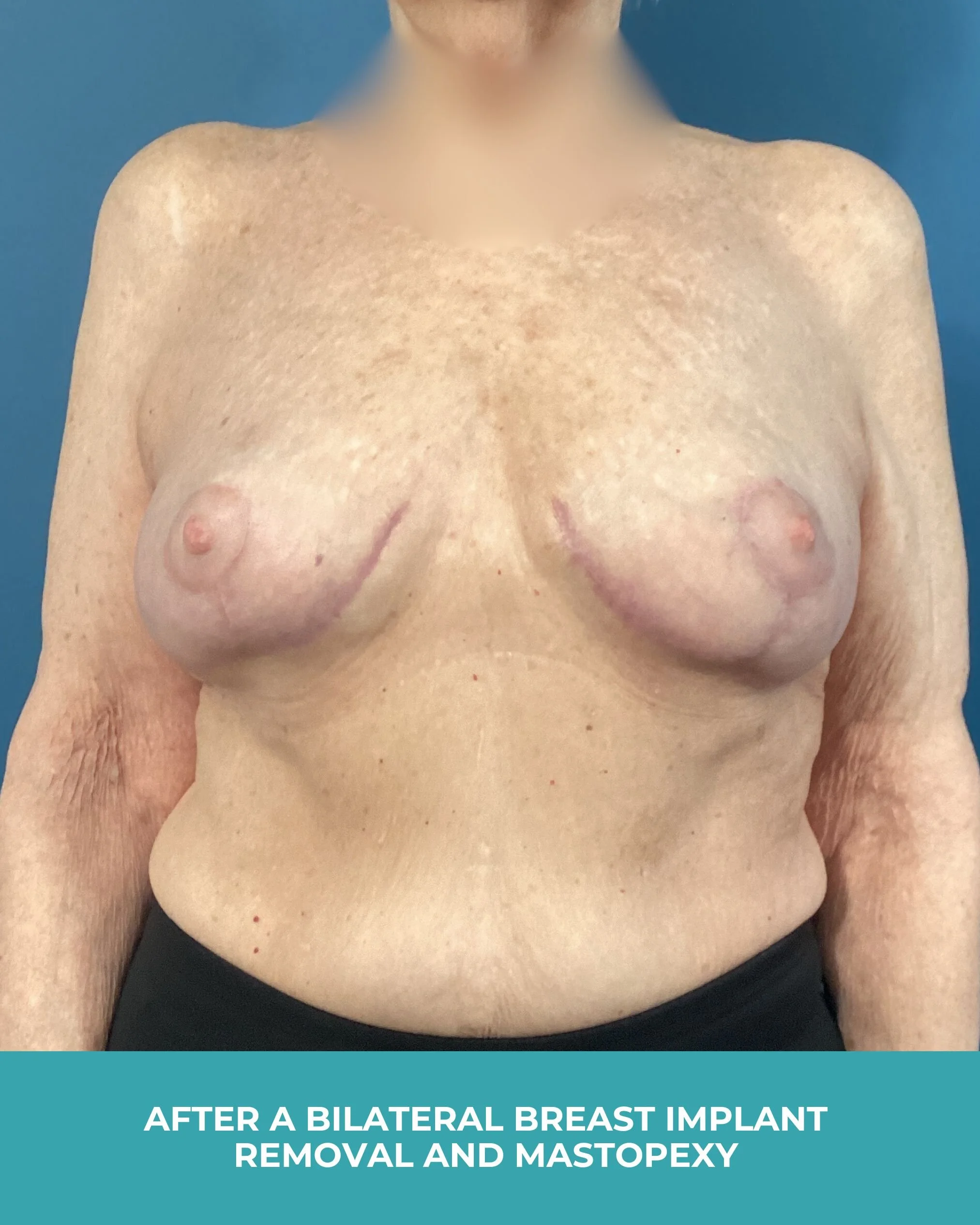 B&A Bilateral Breast Implant Removal and Mastopexy (2).jpg
