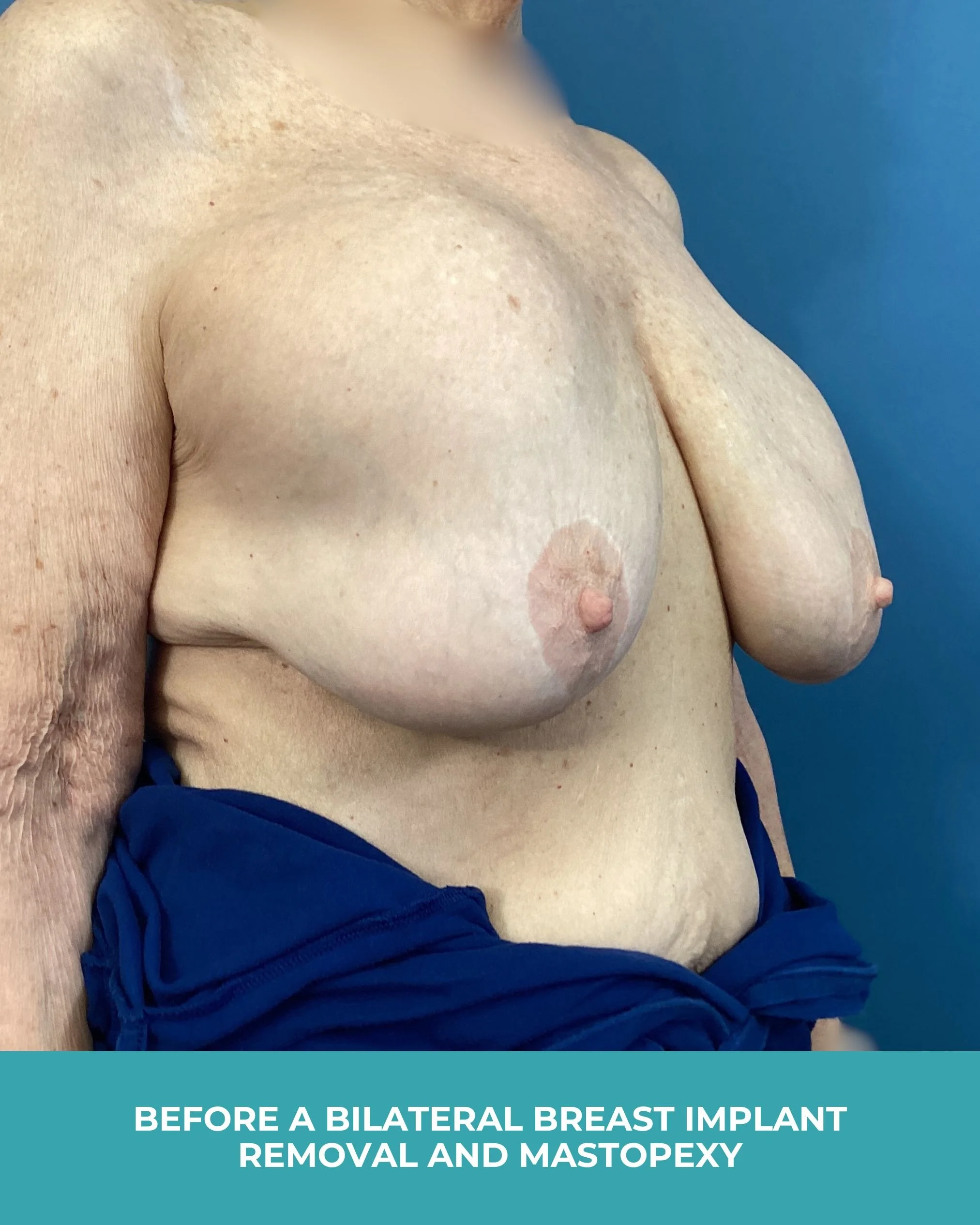 B&A Bilateral Breast Implant Removal and Mastopexy (3).jpg