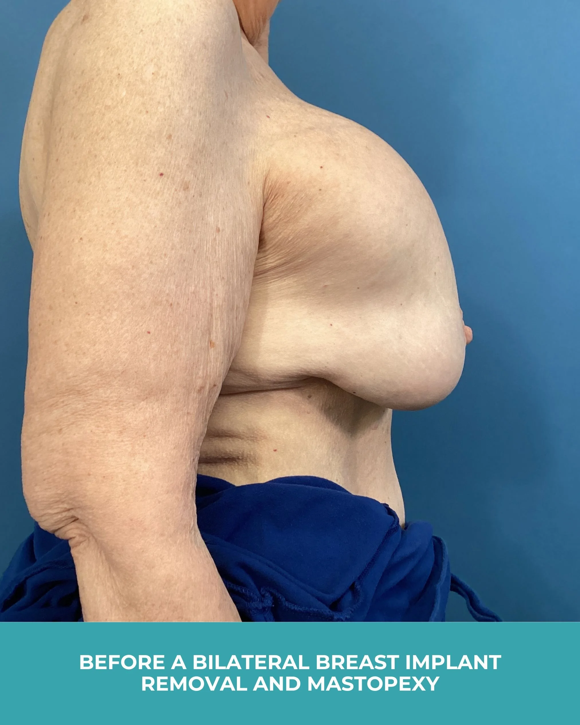 B&A Bilateral Breast Implant Removal and Mastopexy (5).jpg