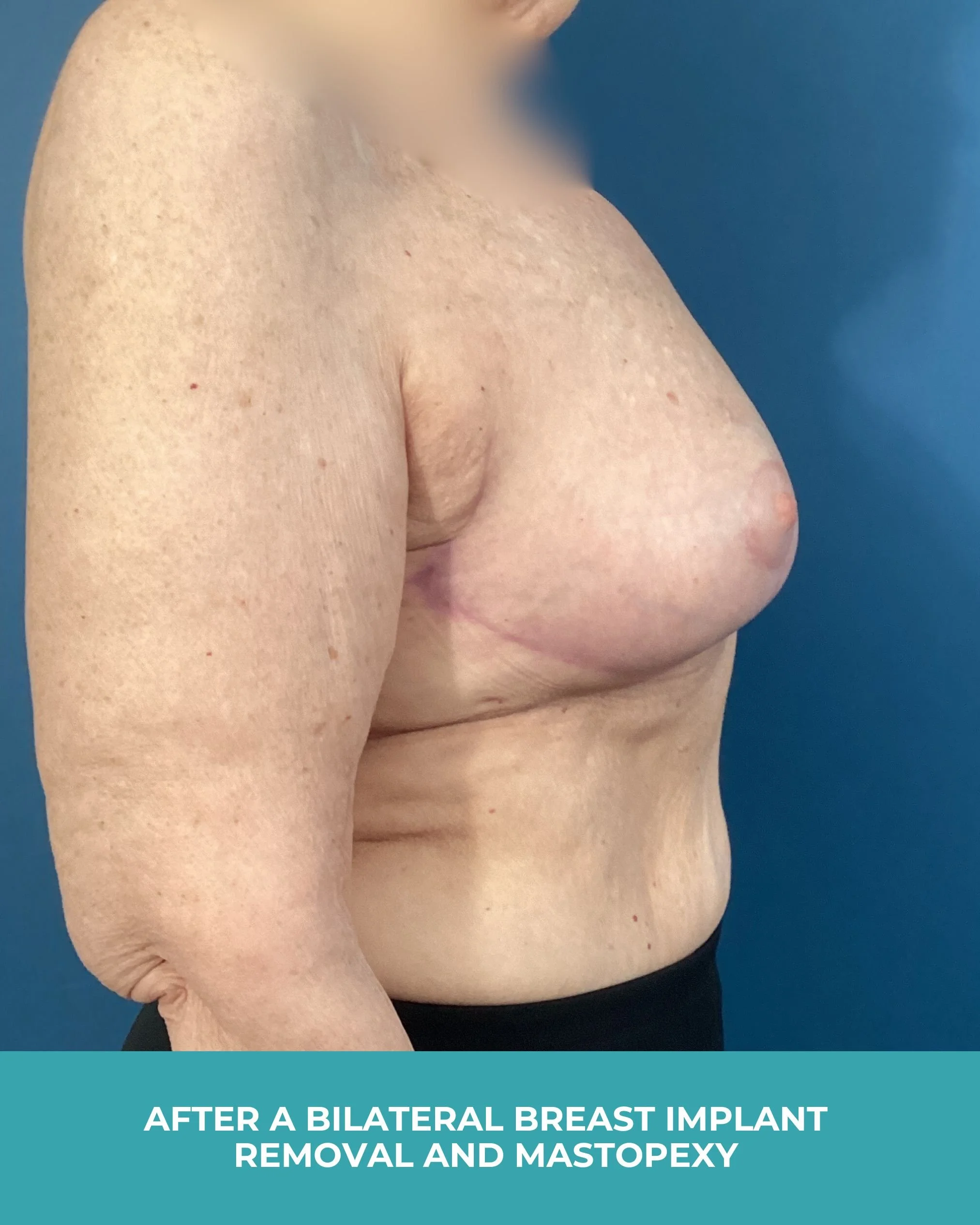 B&A Bilateral Breast Implant Removal and Mastopexy (6).jpg