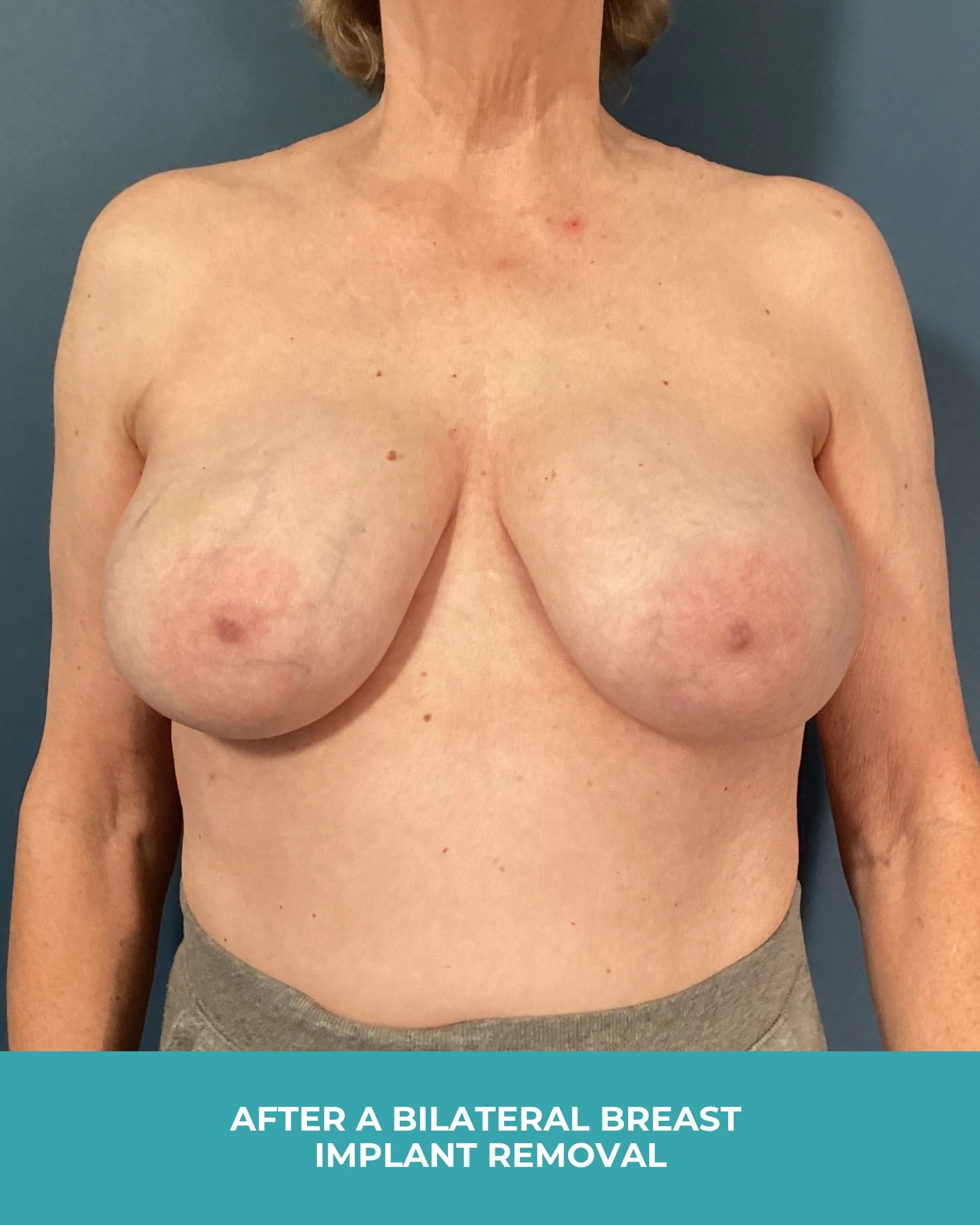 B&A Bilateral Breast Implant Removal (2).jpg