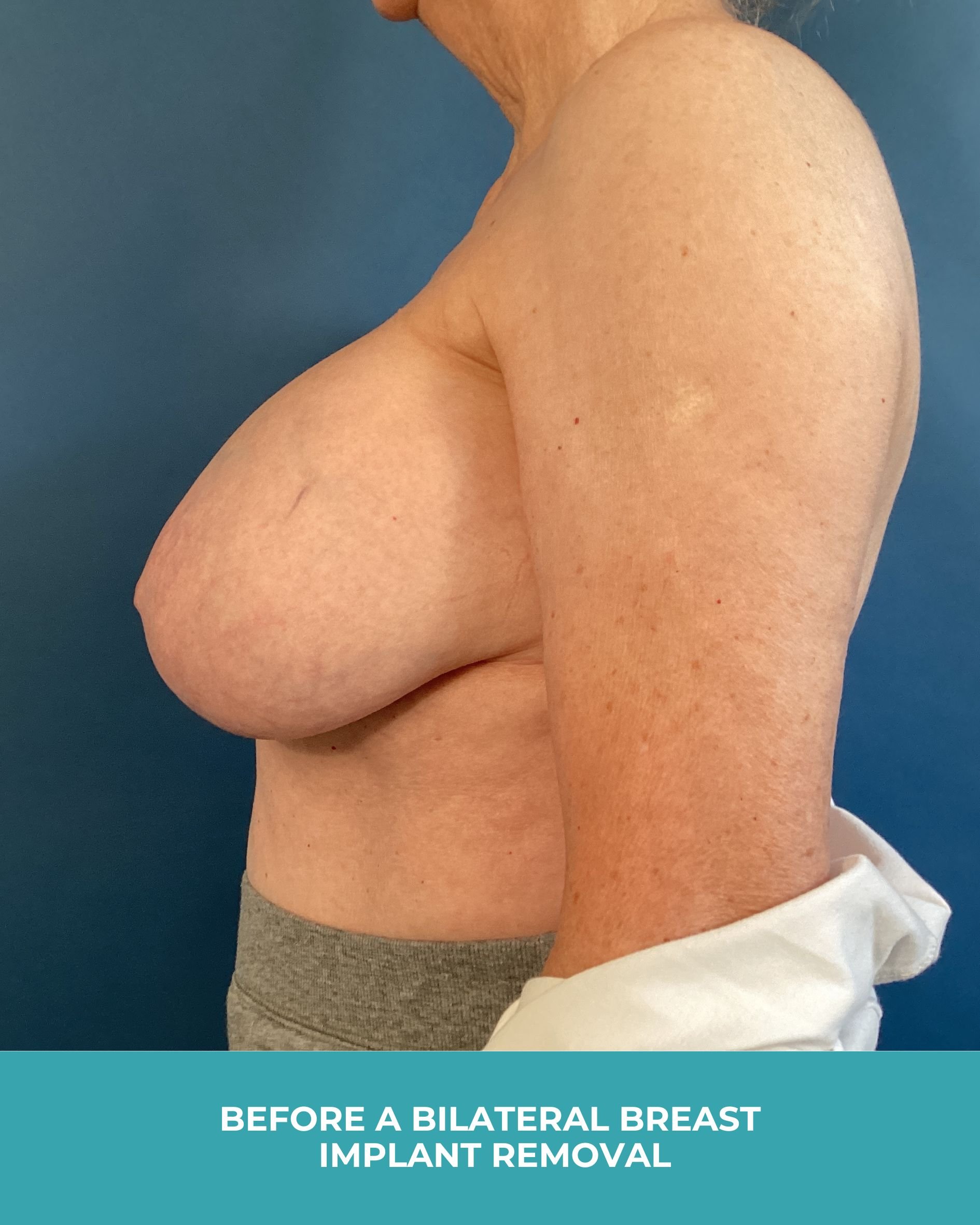 B&A Bilateral Breast Implant Removal (5).jpg