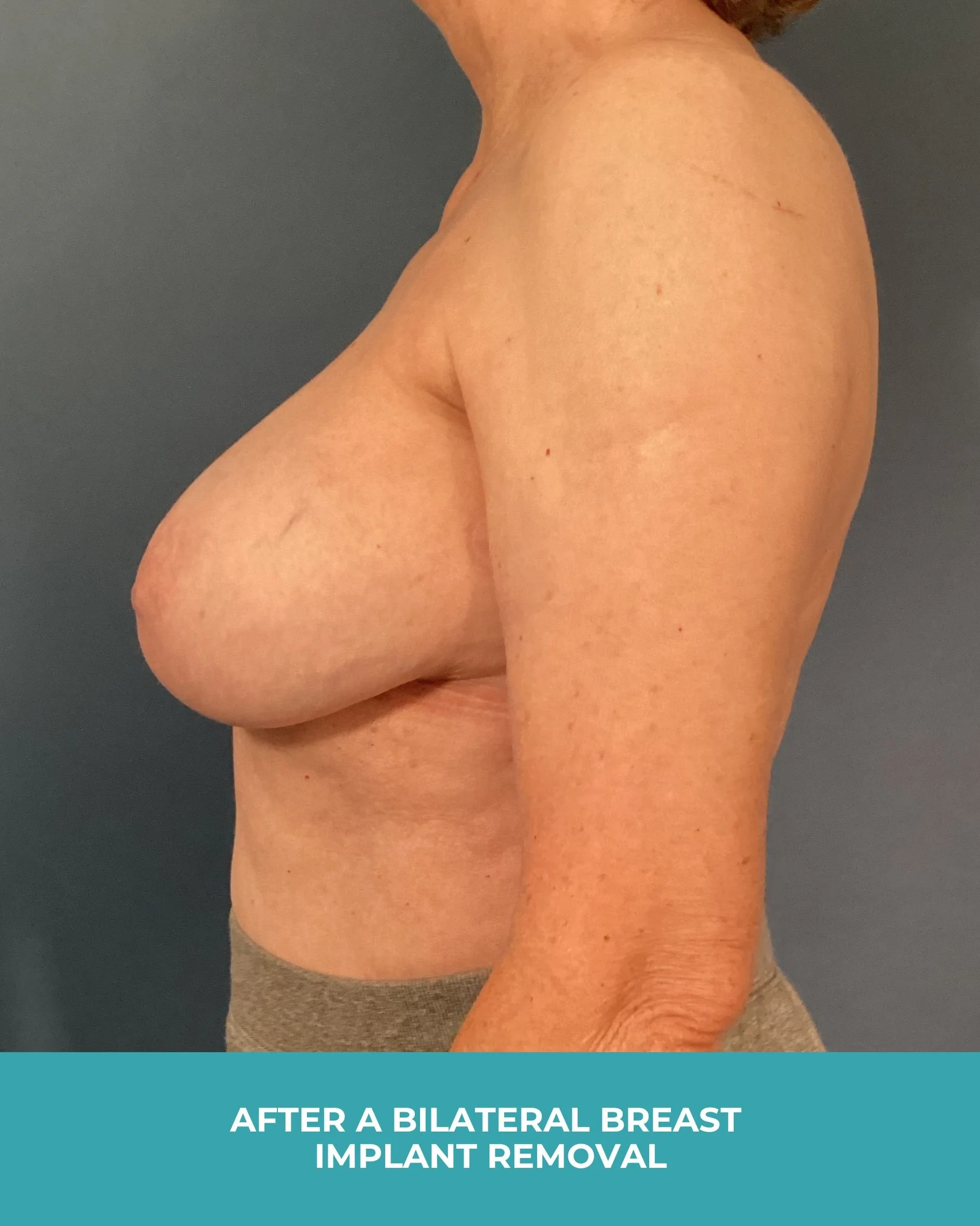 B&A Bilateral Breast Implant Removal (6).jpg