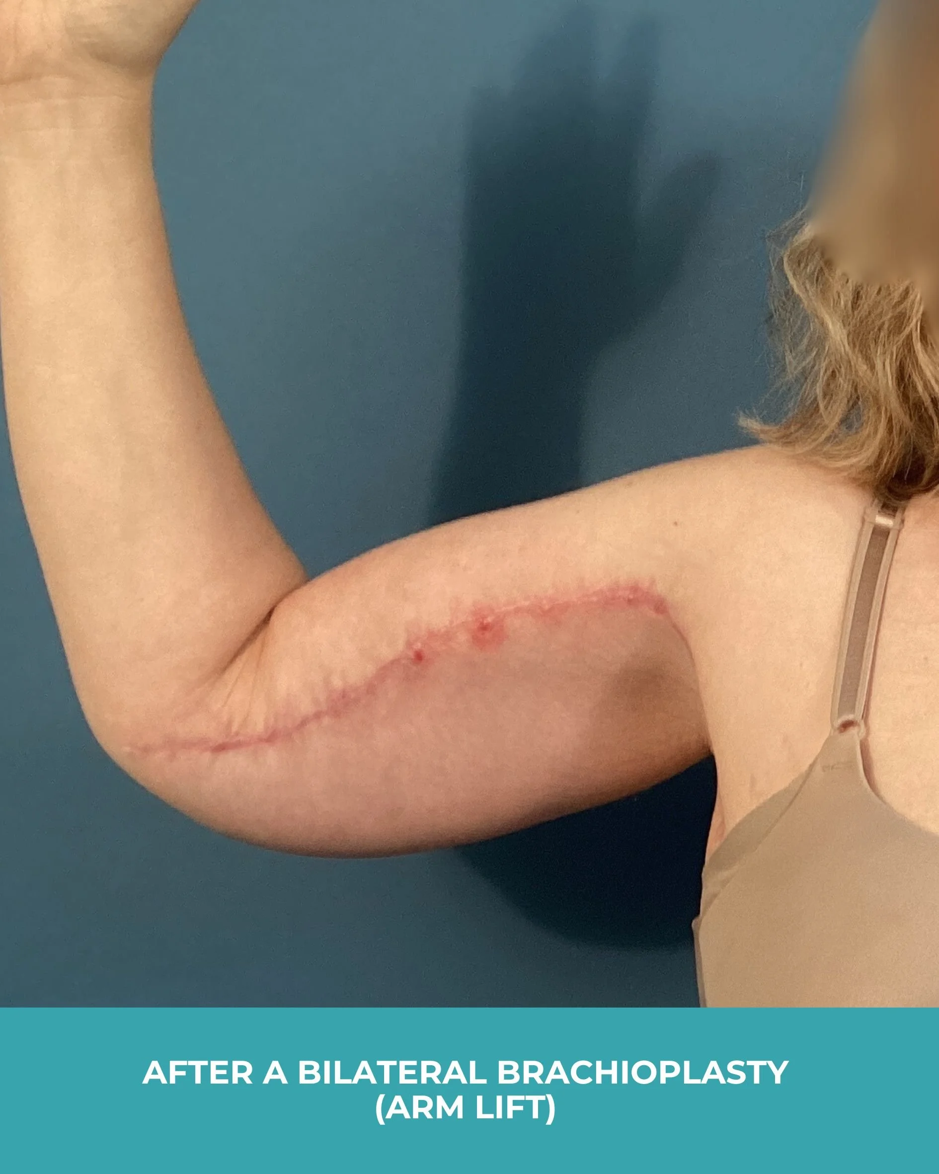 B&A Bilateral Breast Implant Removal (4).jpg