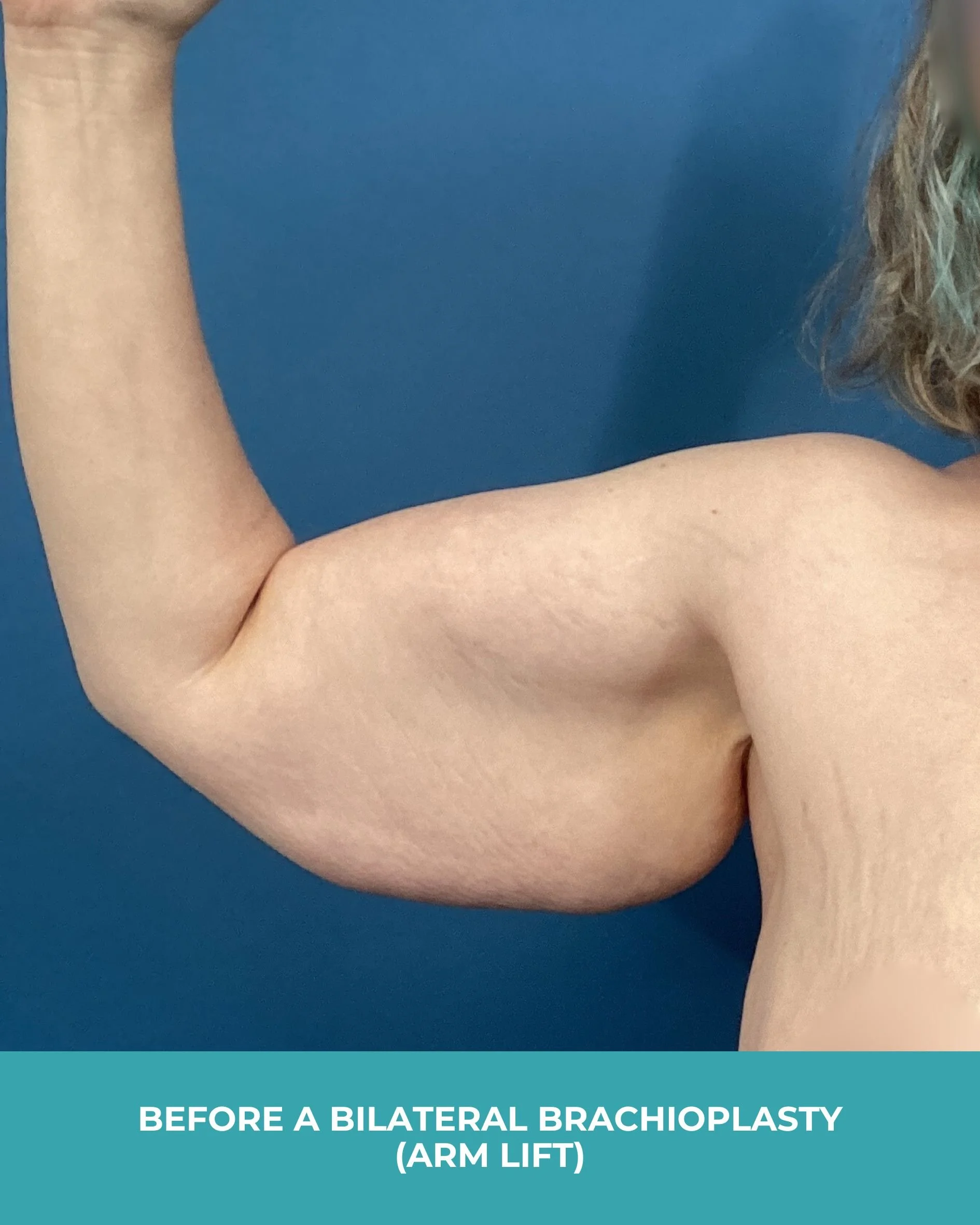 B&A Bilateral Breast Implant Removal (3).jpg