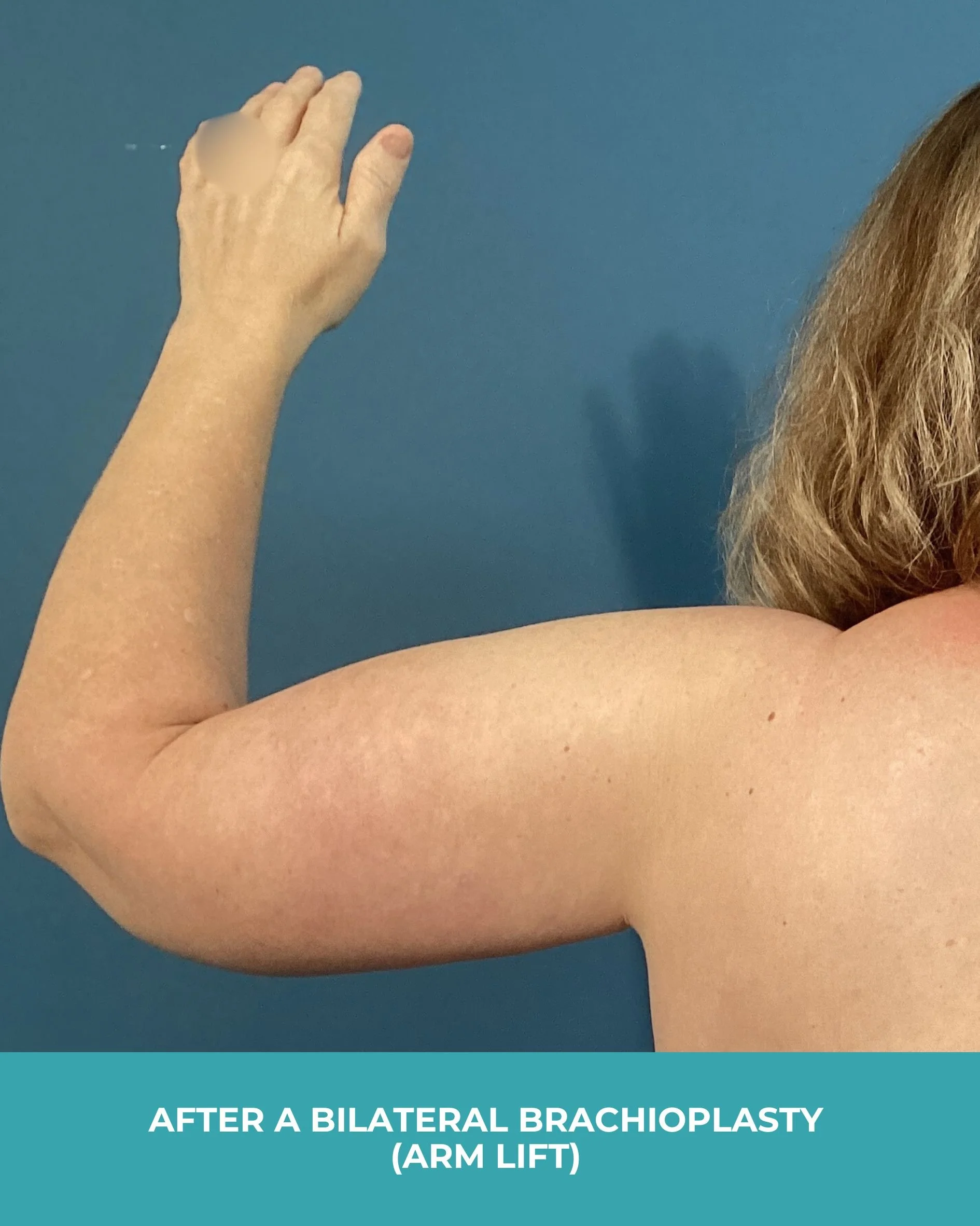 B&A Bilateral Breast Implant Removal (2).jpg
