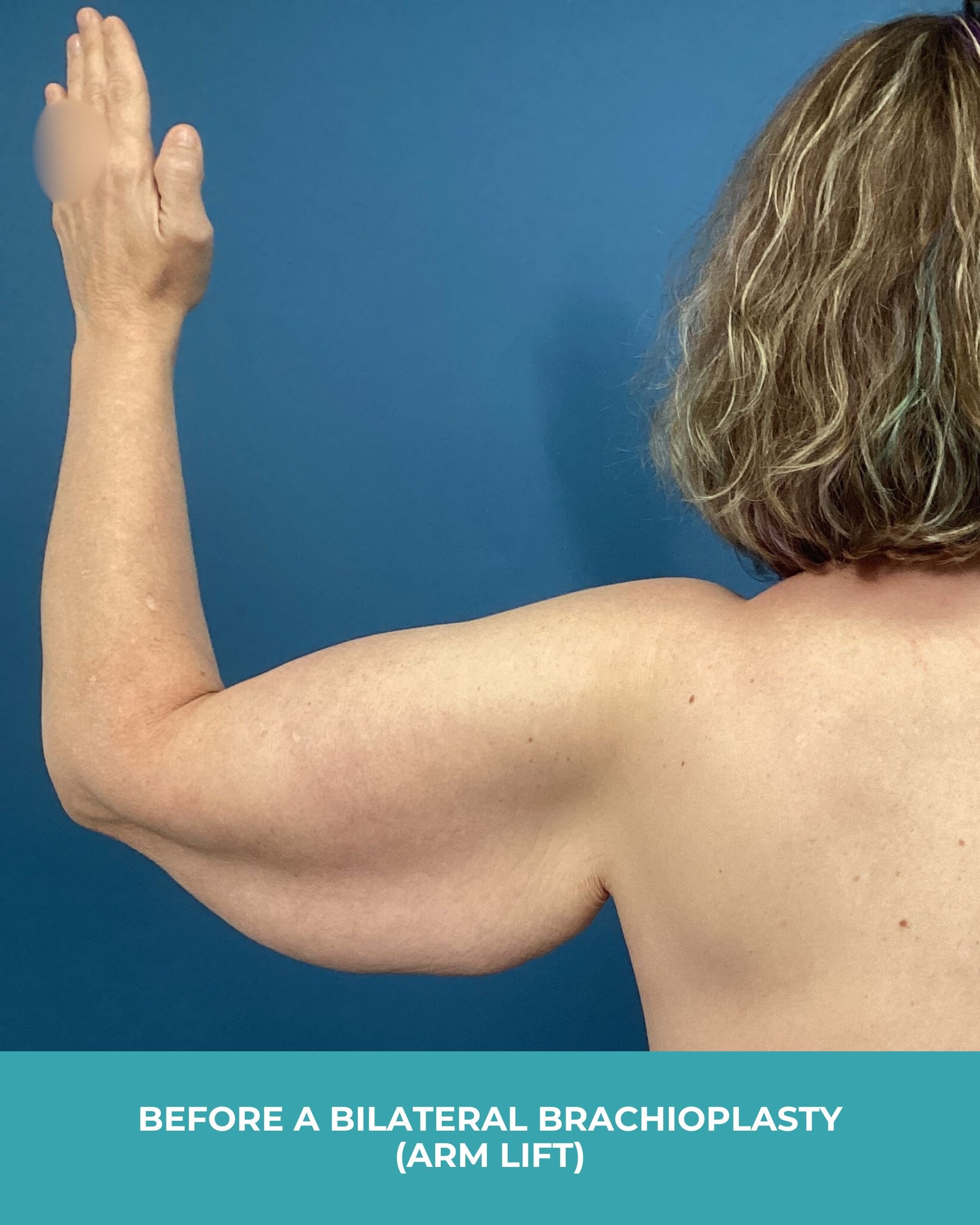 B&A Bilateral Breast Implant Removal.jpg