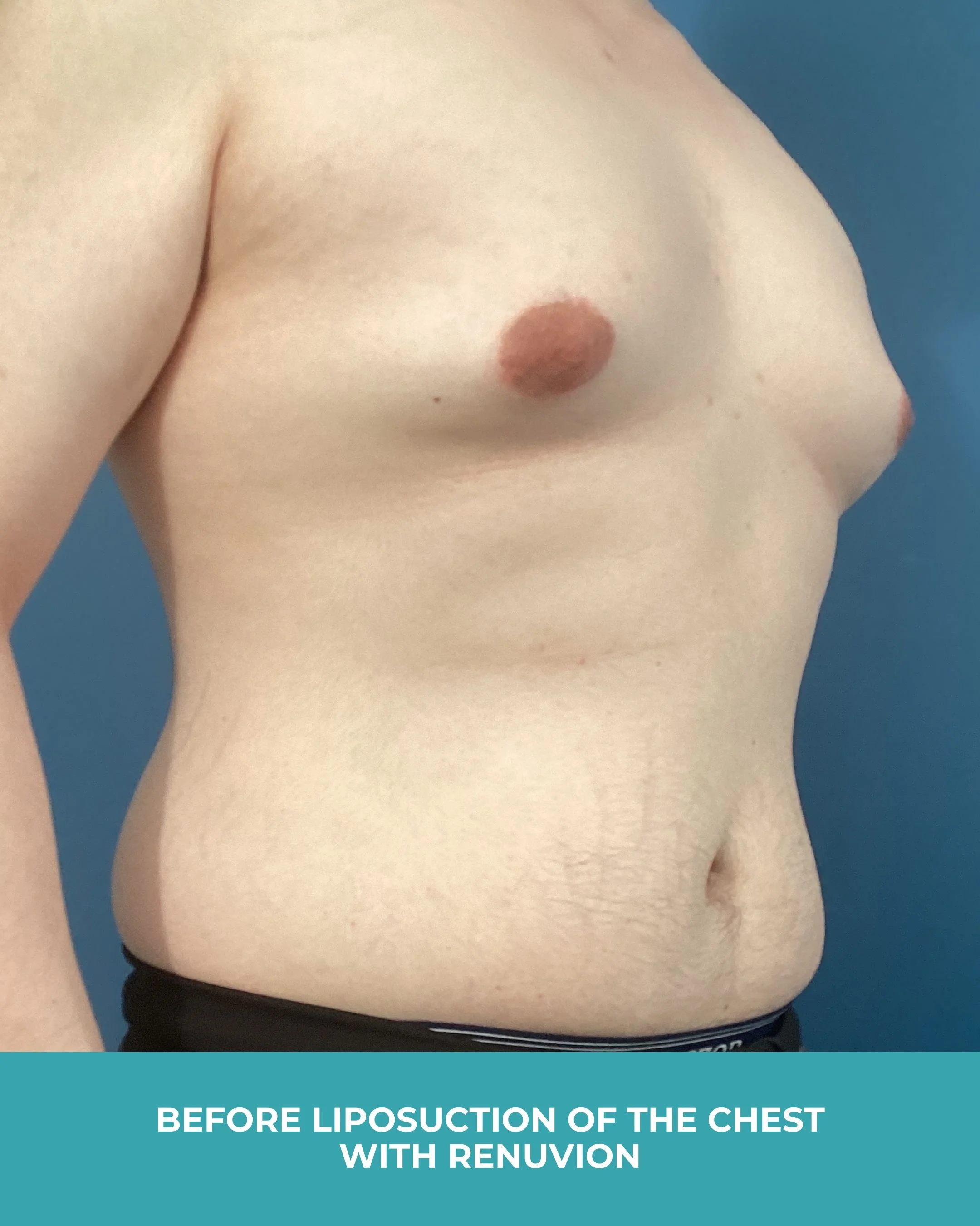 B&A liposuction of the chest with renuvion (3).jpg