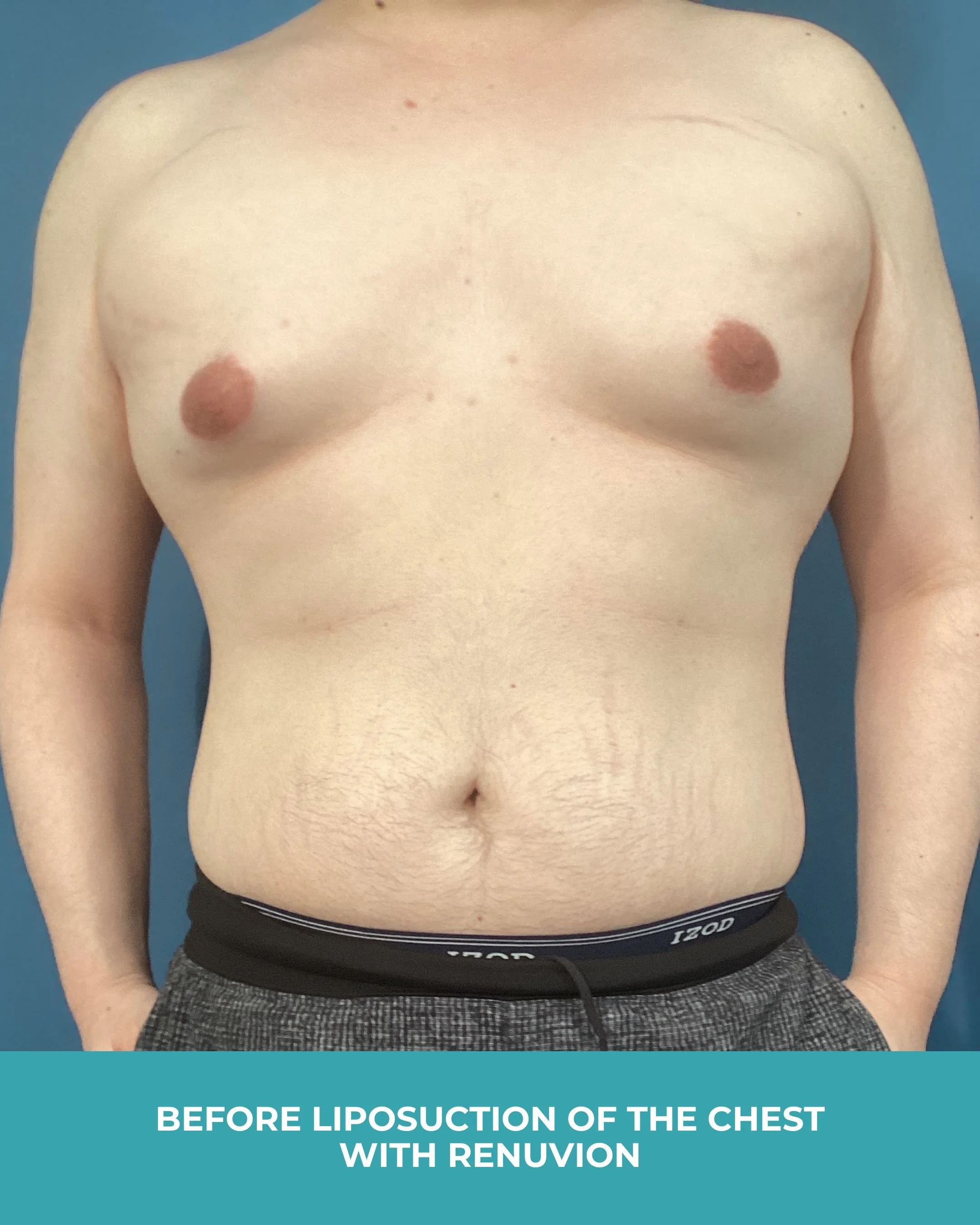 B&A liposuction of the chest with renuvion (5).jpg