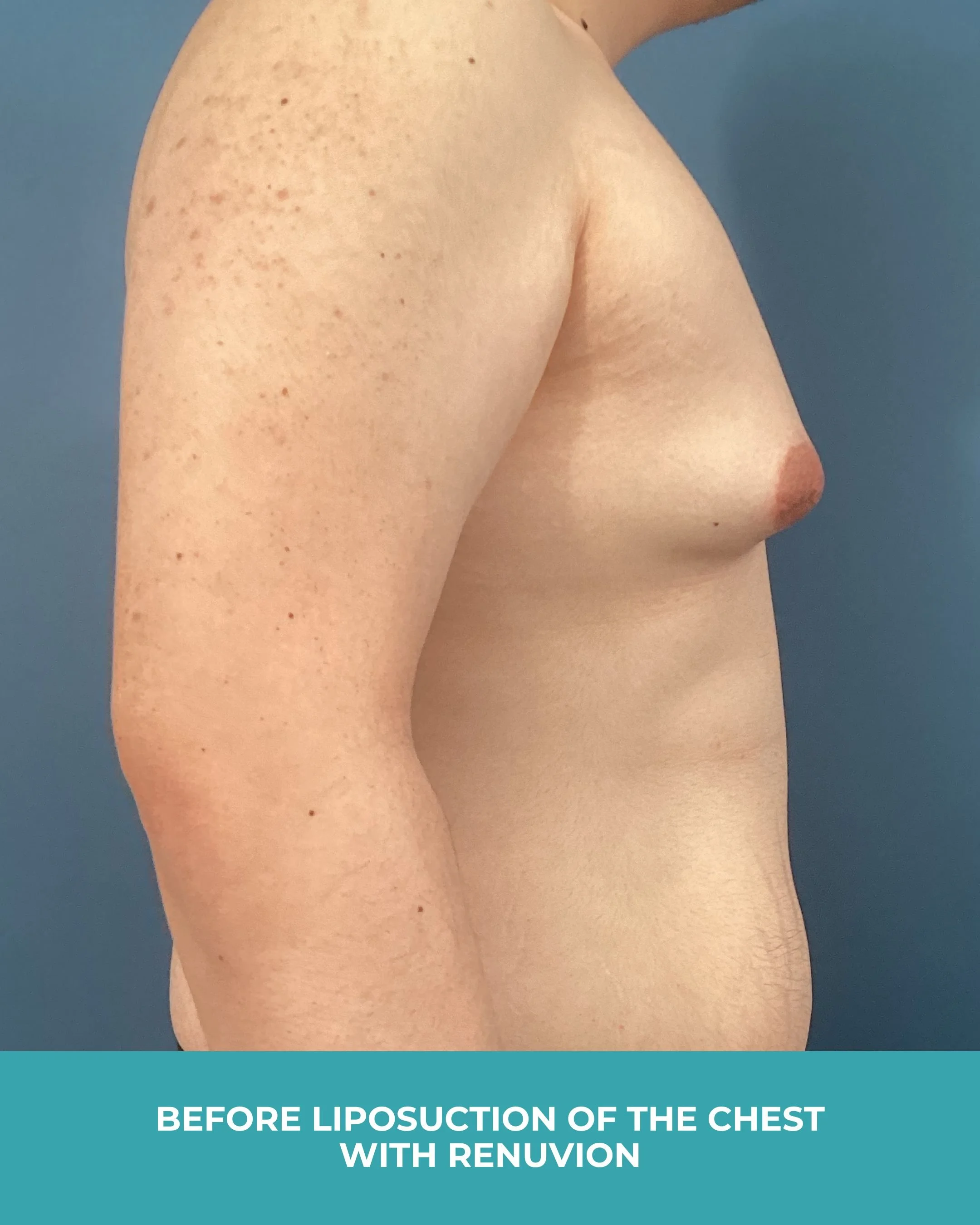 B&A liposuction of the chest with renuvion.jpg