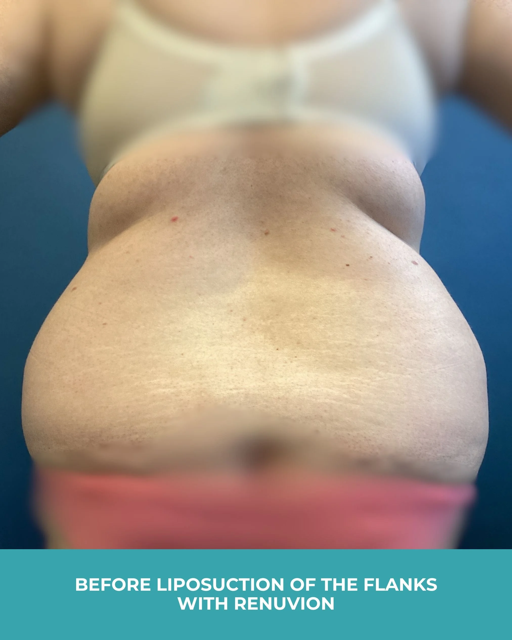B&A liposuction of the flanks with renuvion (3).jpg