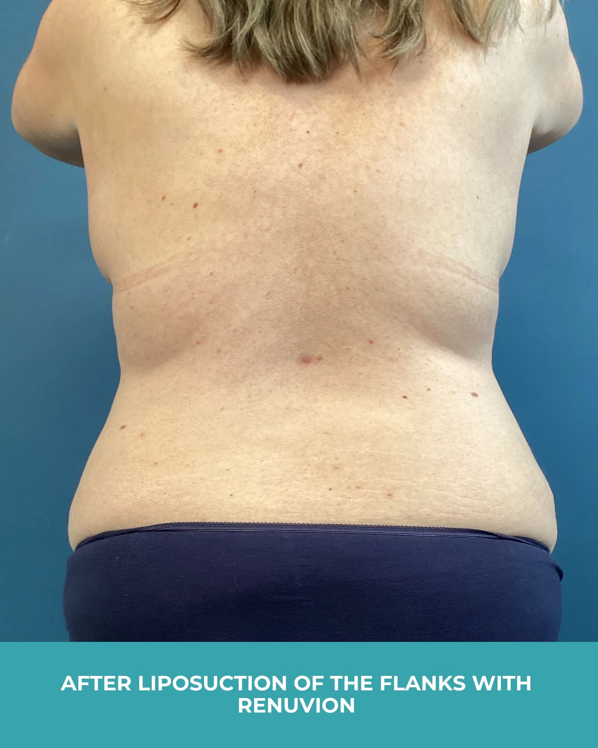 B&A liposuction of the flanks with renuvion (4).jpg