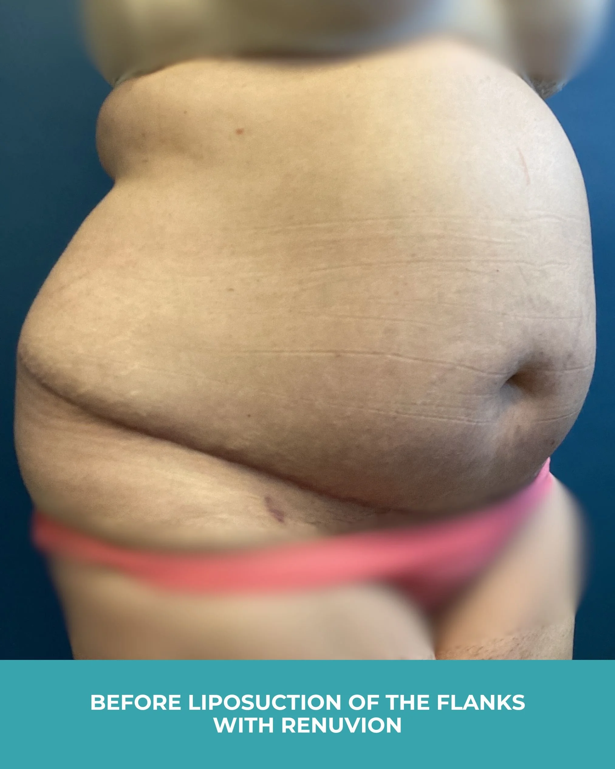 B&A liposuction of the flanks with renuvion.jpg