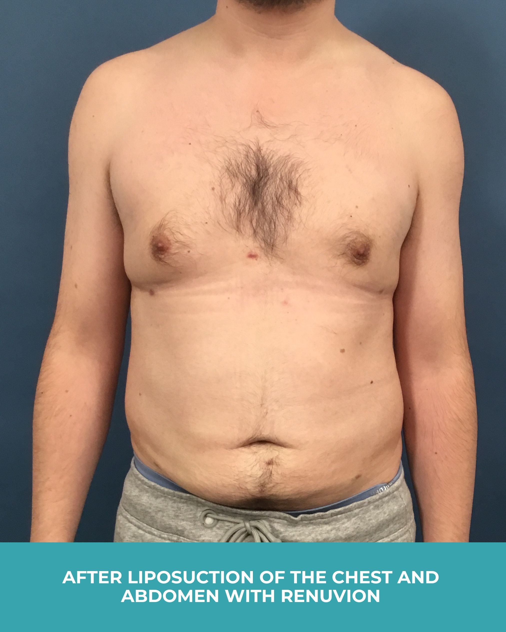 B&A liposuction of the chest and abdomen with renuvion (2).jpg