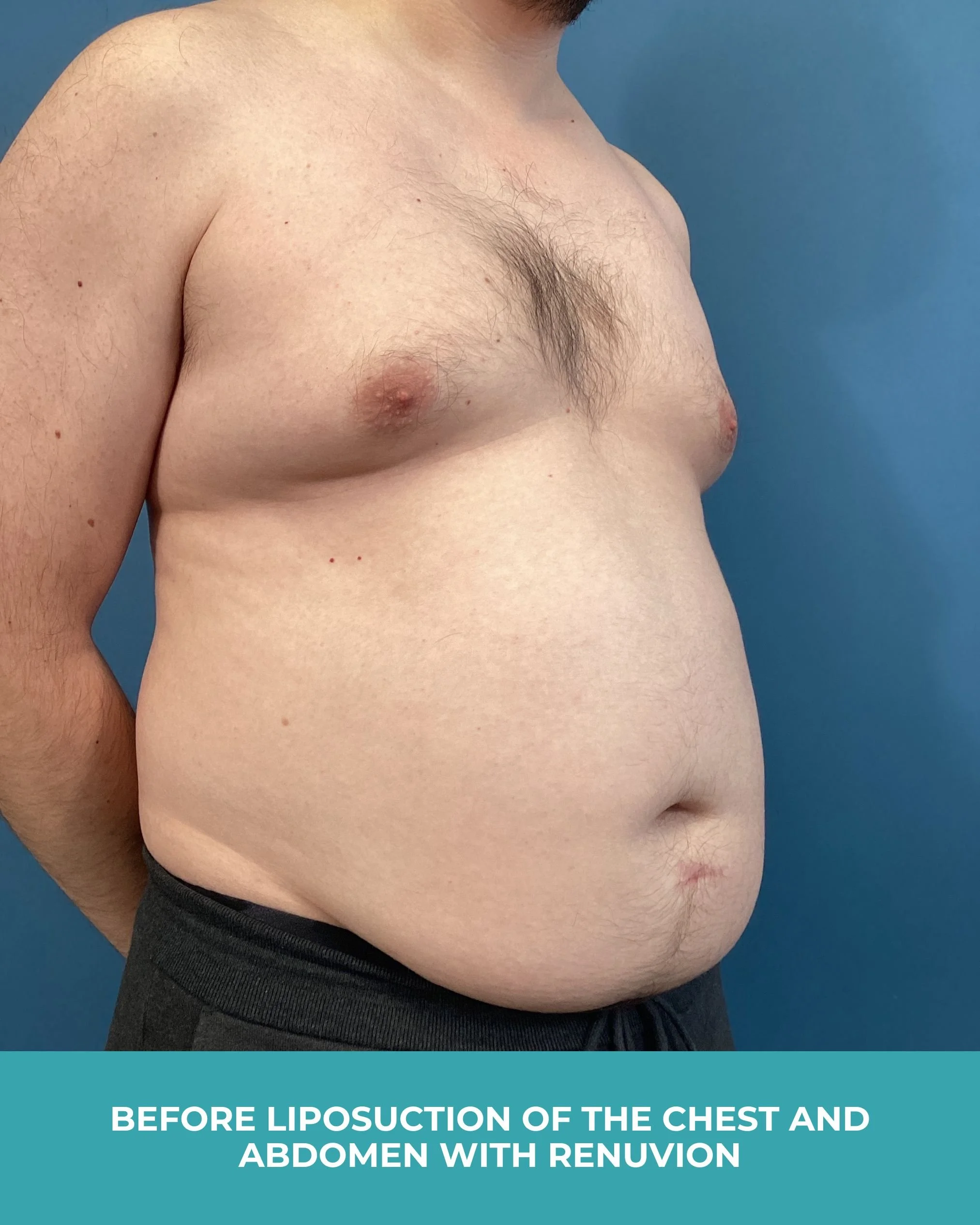 B&A liposuction of the chest and abdomen with renuvion (3).jpg