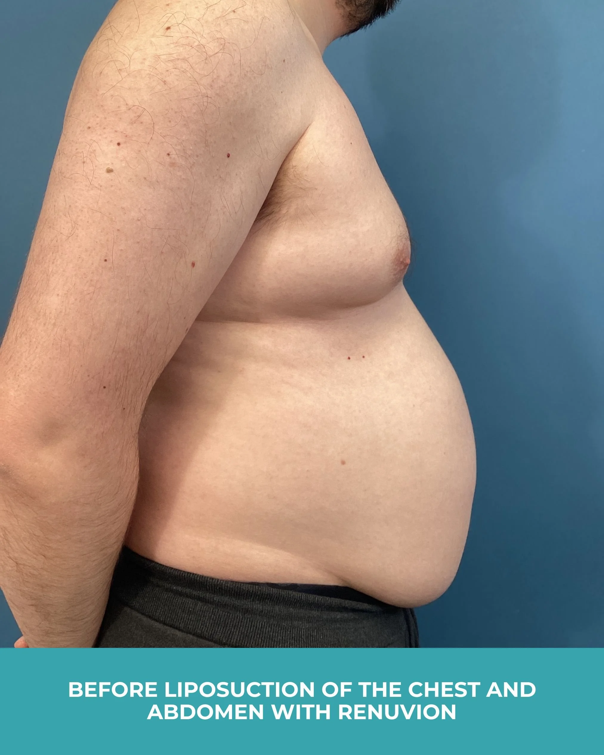 B&A liposuction of the chest and abdomen with renuvion (5).jpg