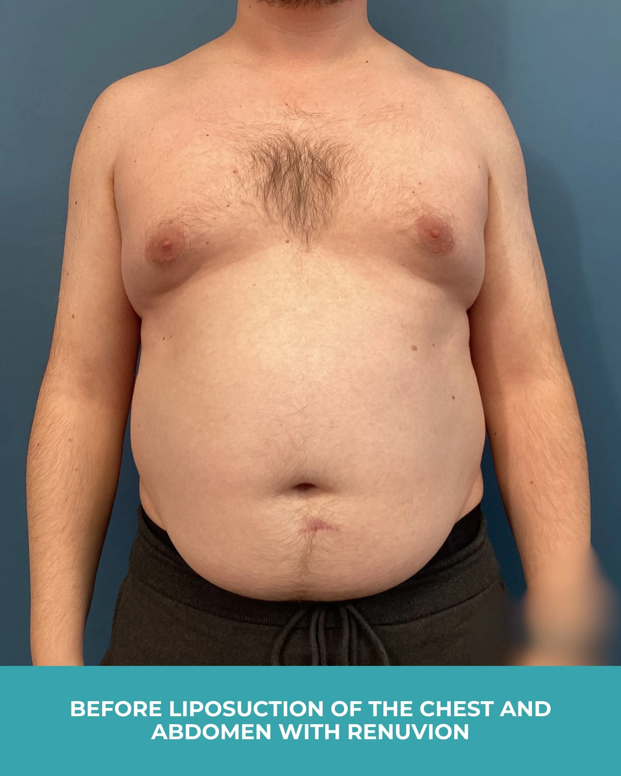B&A liposuction of the chest and abdomen with renuvion.jpg
