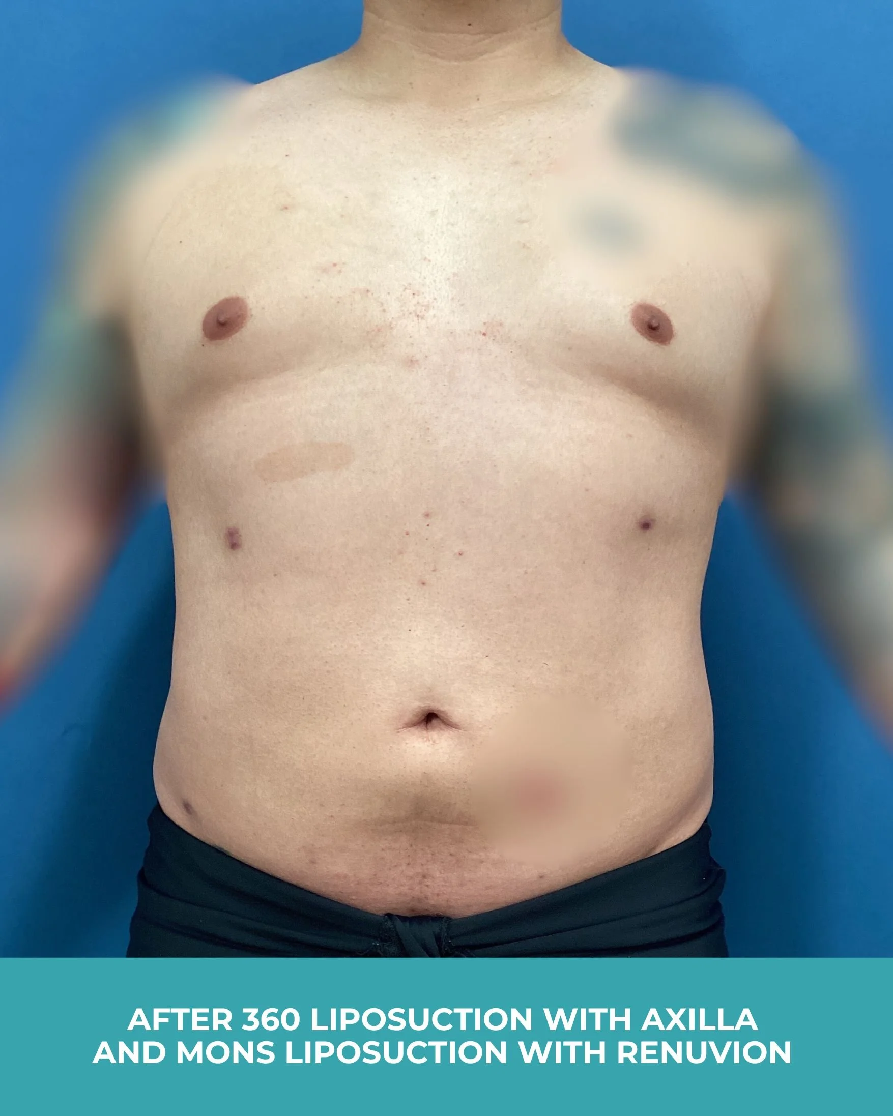 B&A 360 liposuction with axilla and mons liposuction with Renuvion (2).jpg