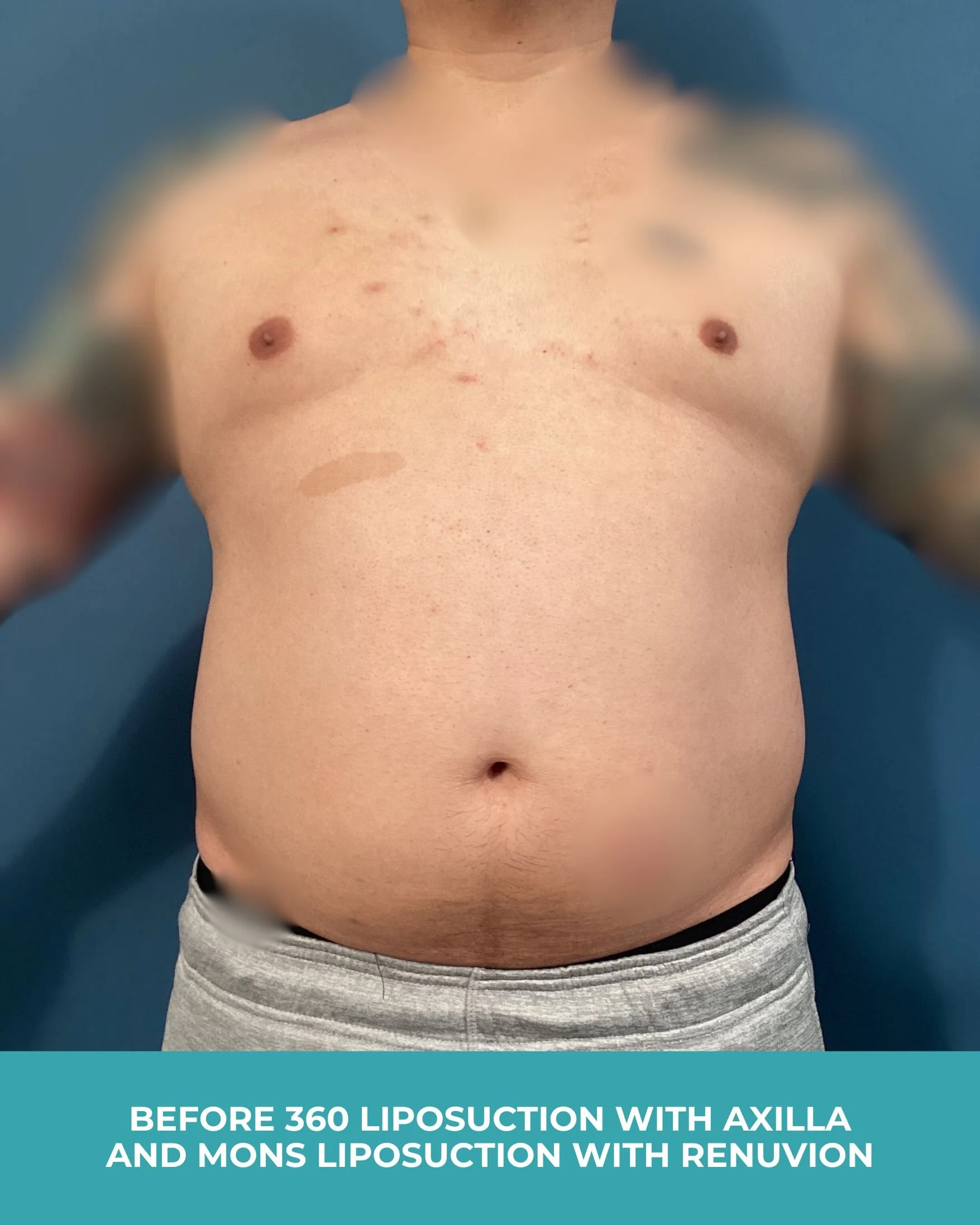 B&A 360 liposuction with axilla and mons liposuction with Renuvion.jpg