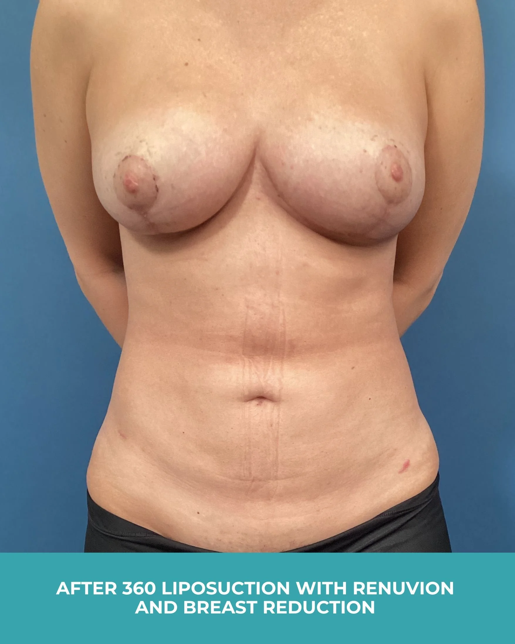 B&A 360 liposuction with Renuvion and breast reduction (2).jpg