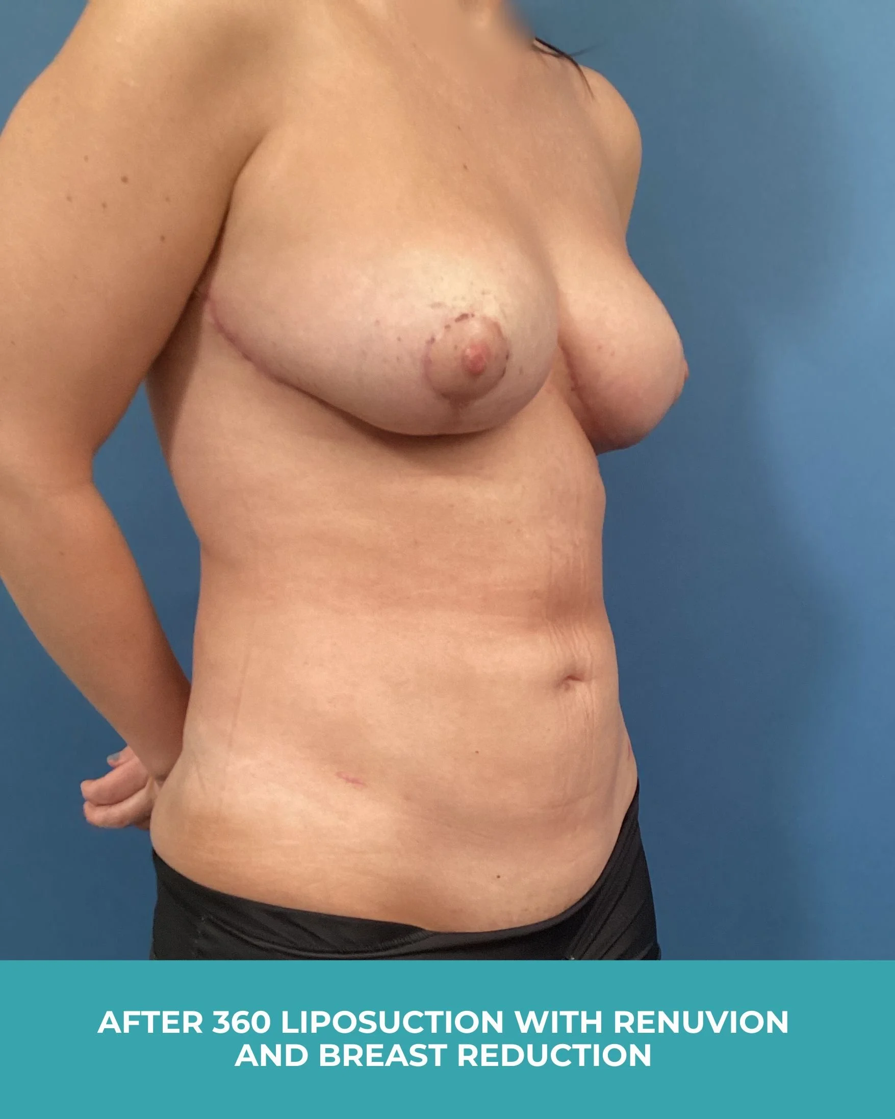 B&A 360 liposuction with Renuvion and breast reduction (4).jpg