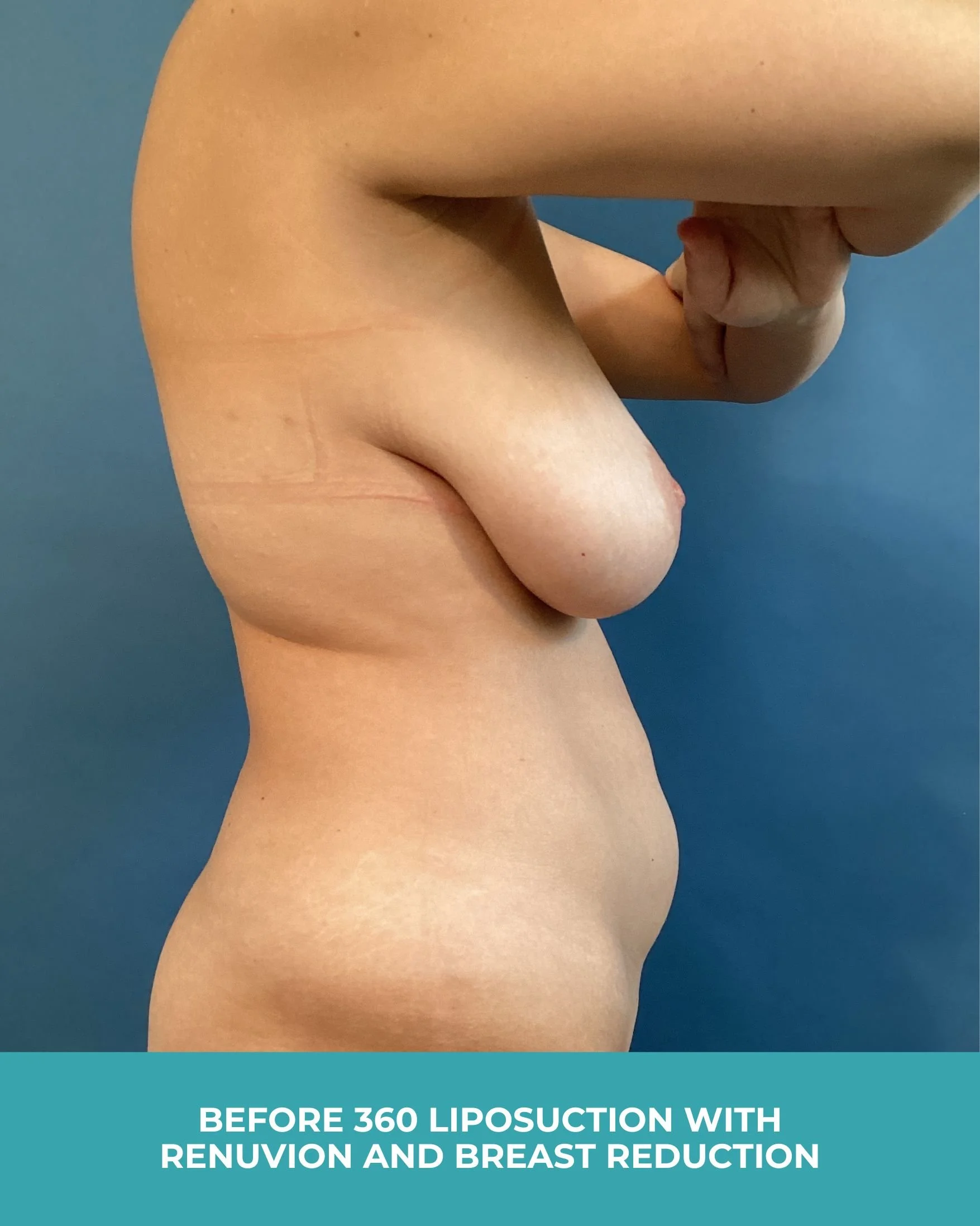 B&A 360 liposuction with Renuvion and breast reduction (5).jpg