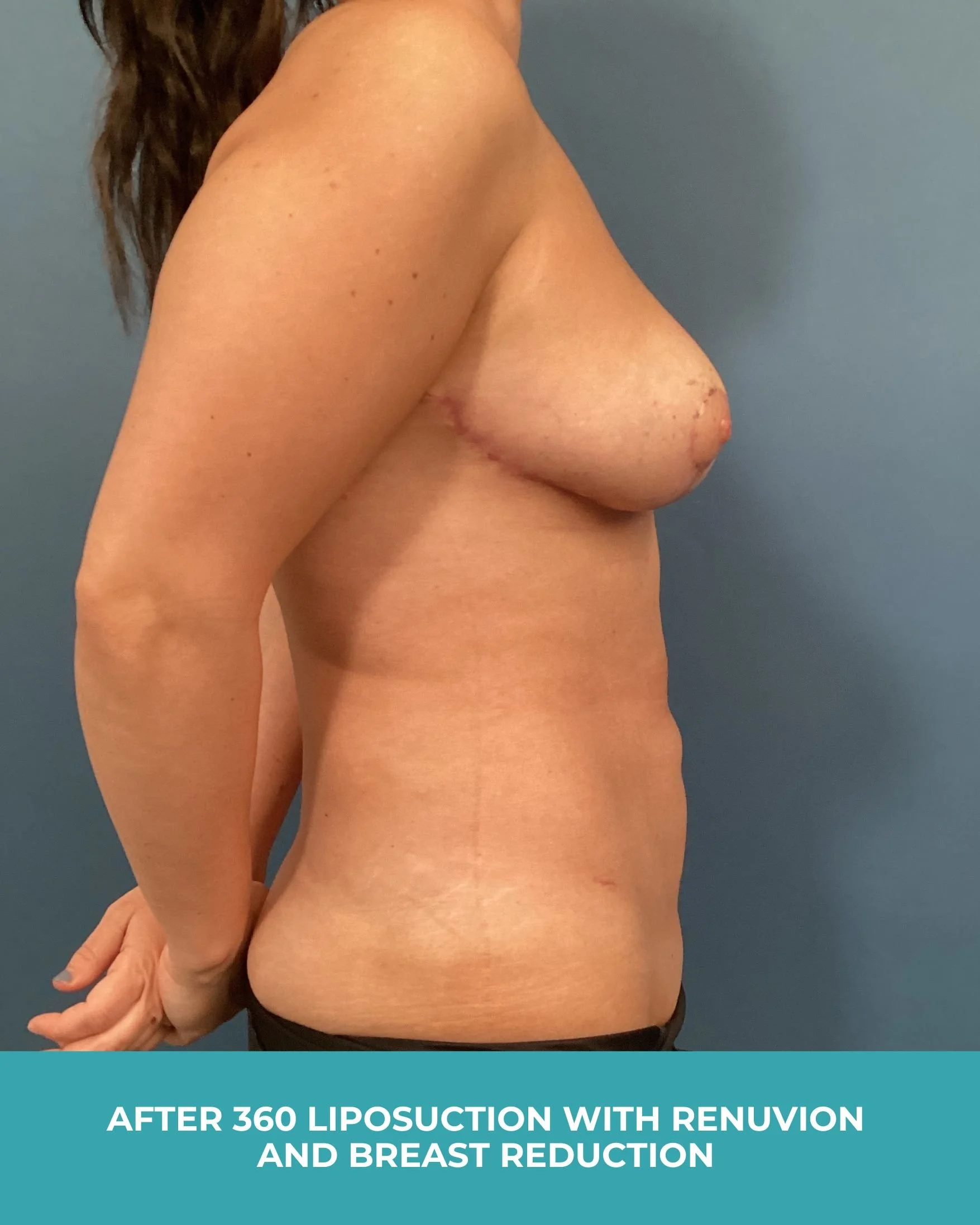 B&A 360 liposuction with Renuvion and breast reduction (6).jpg