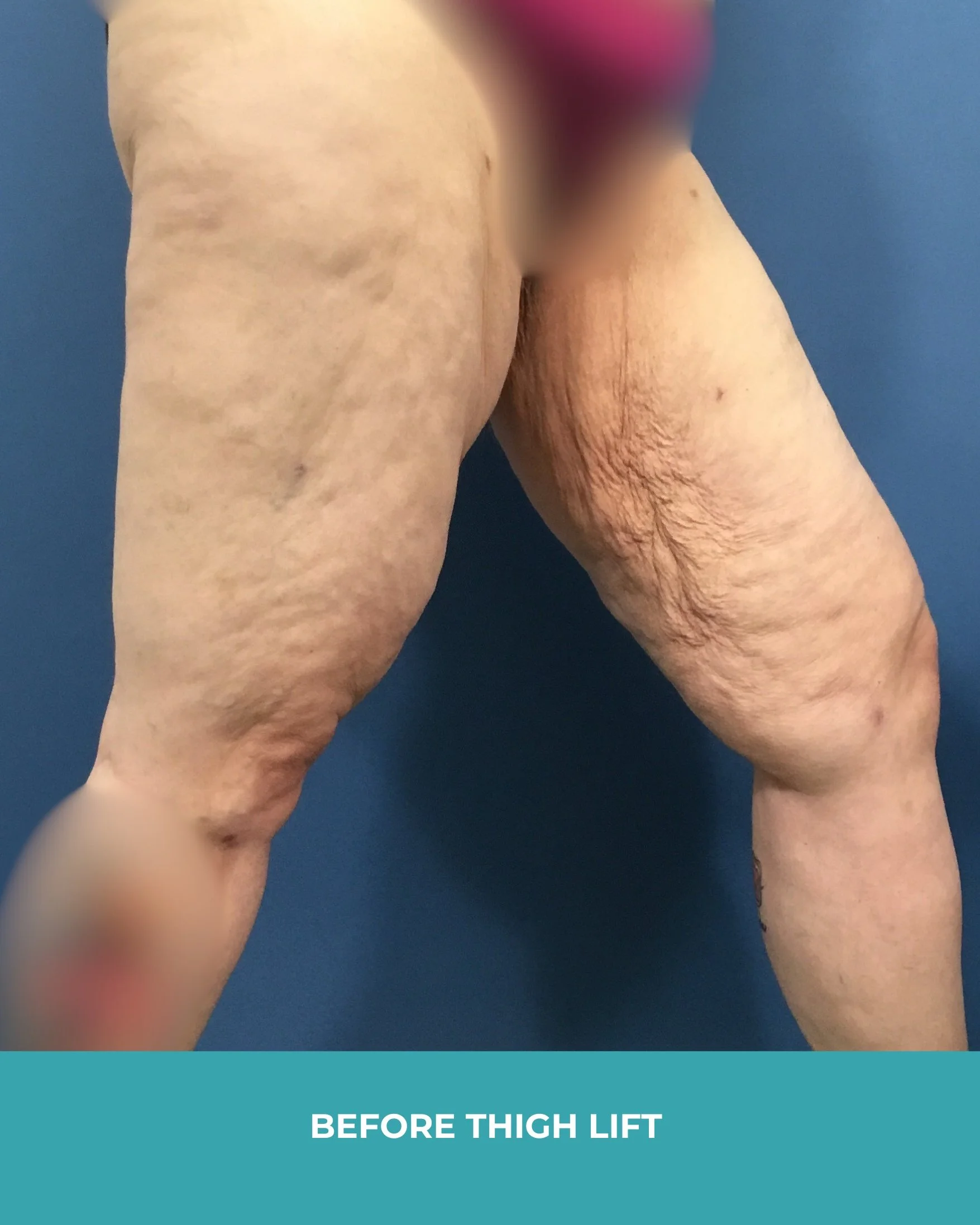 B&A thigh lift (3).jpg