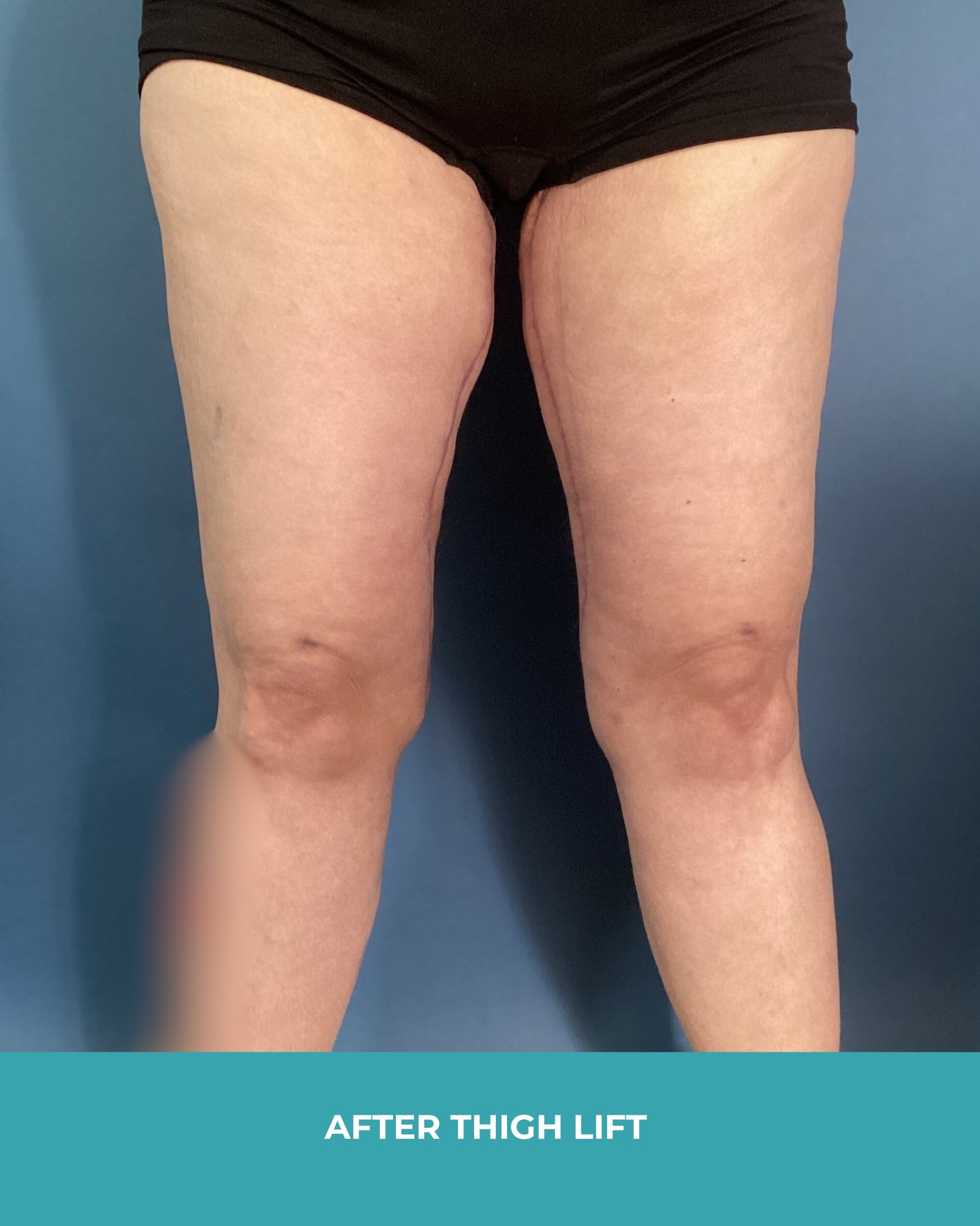 B&A thigh lift (2).jpg