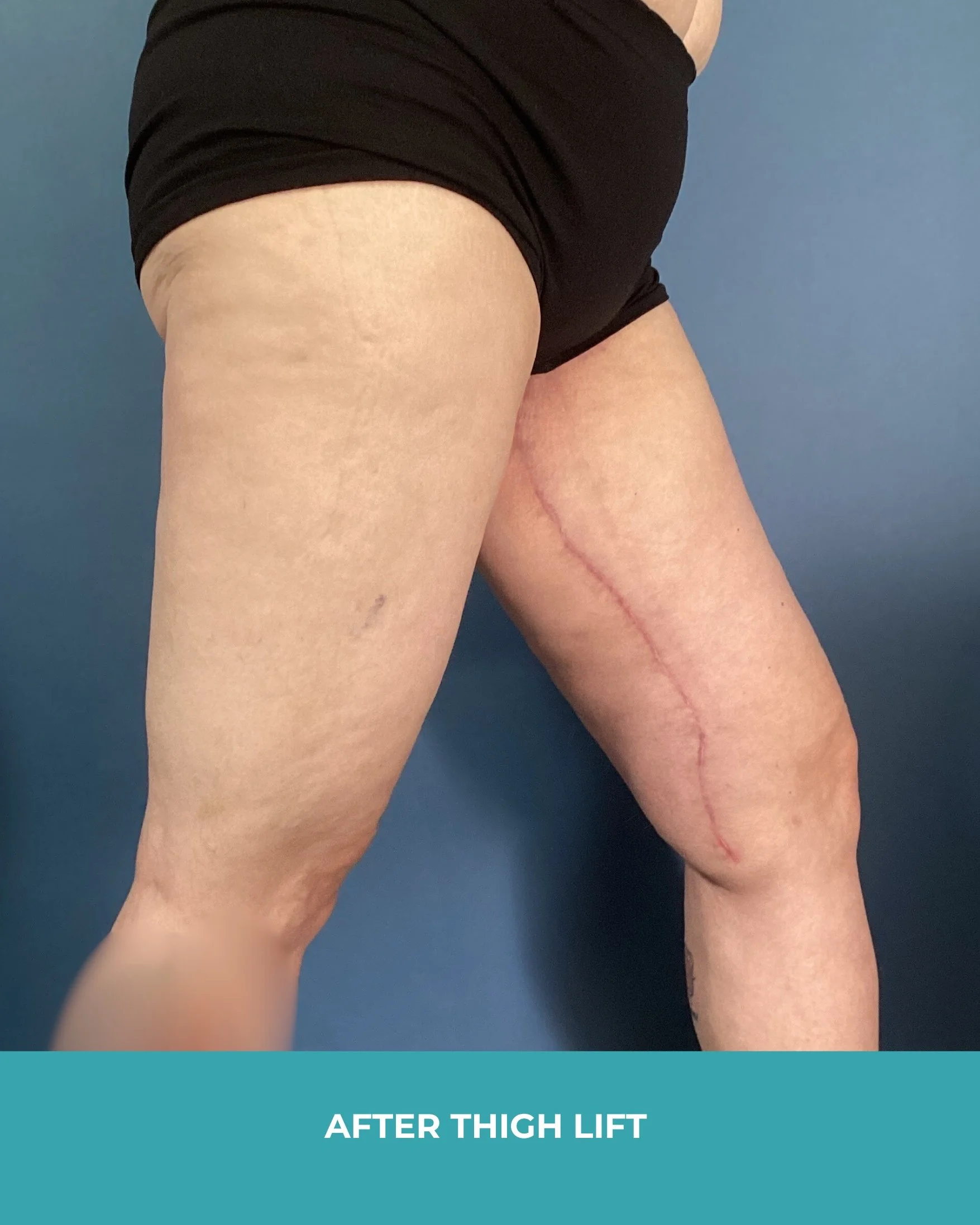 B&A thigh lift (4).jpg