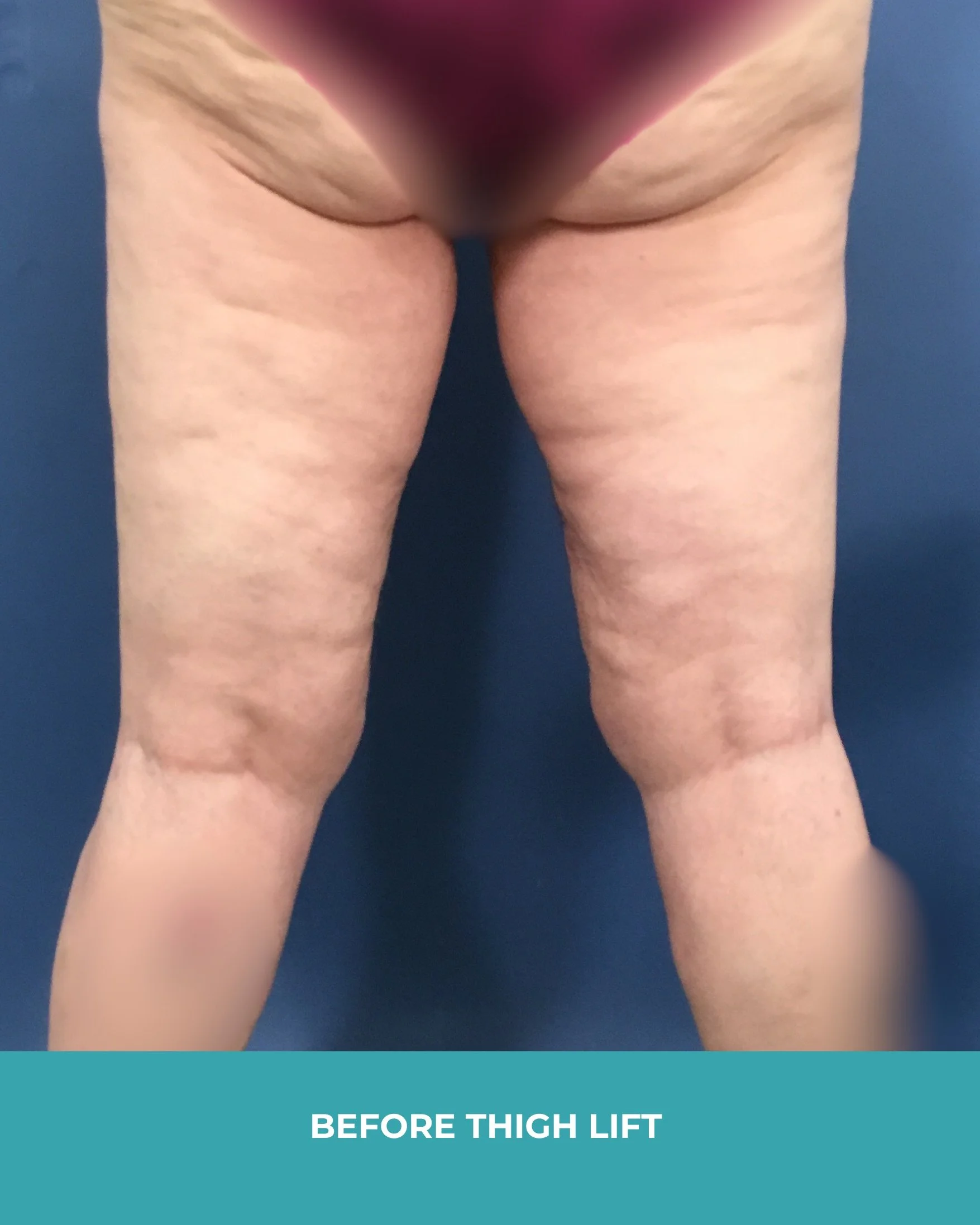 B&A thigh lift (5).jpg