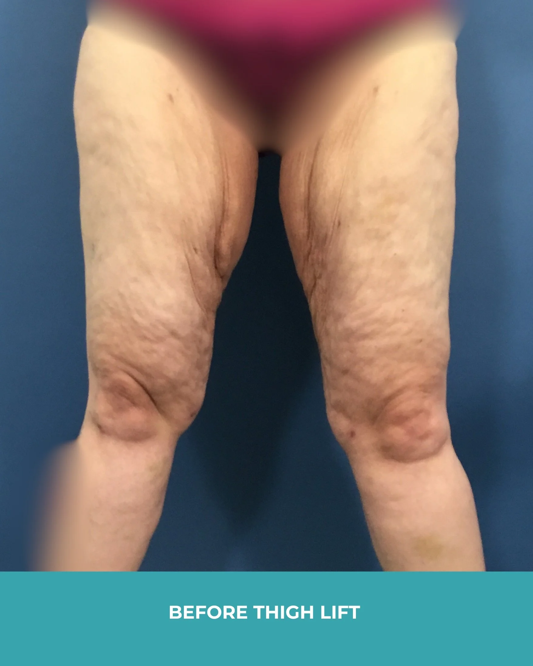 B&A thigh lift.jpg