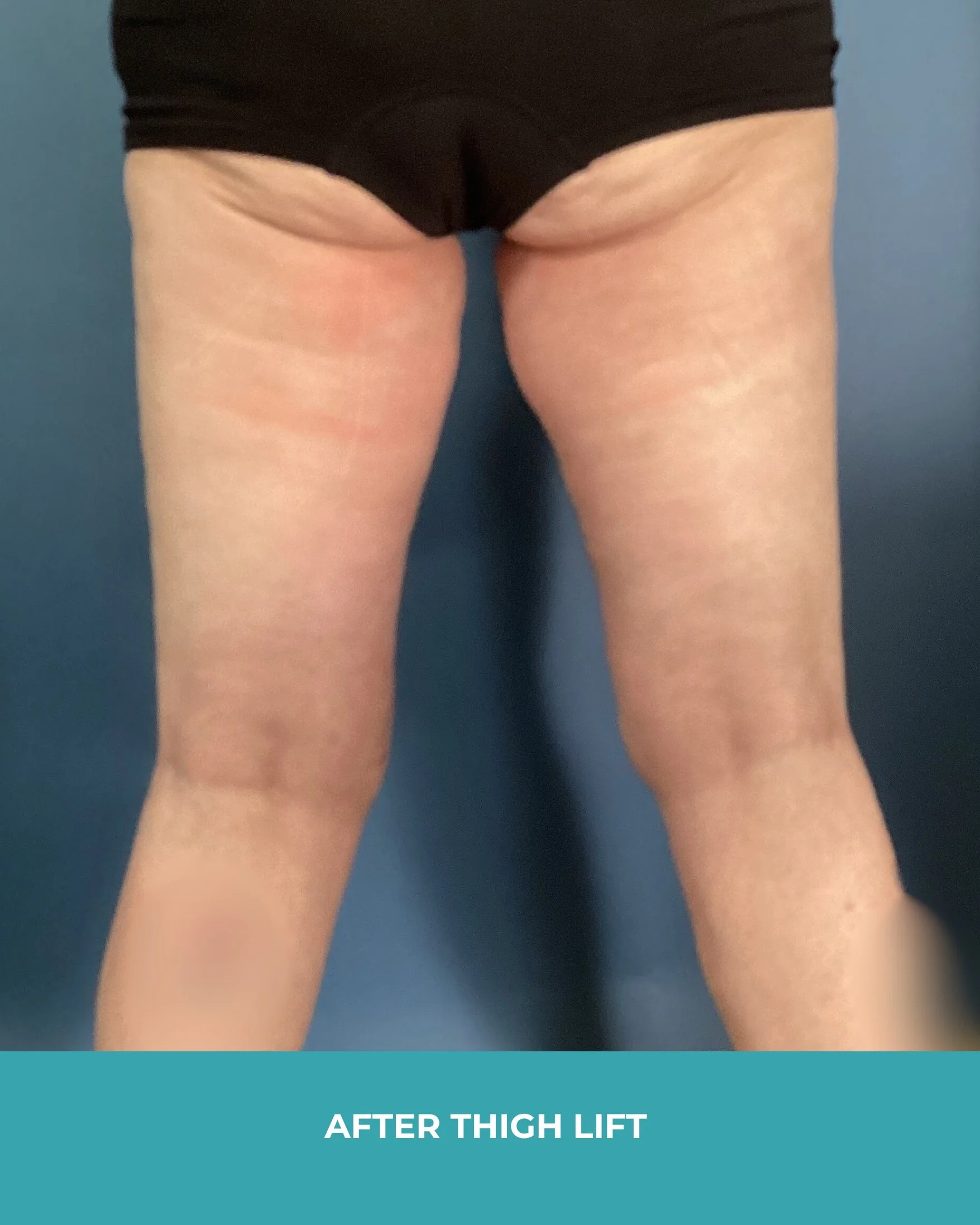 B&A thigh lift (6).jpg