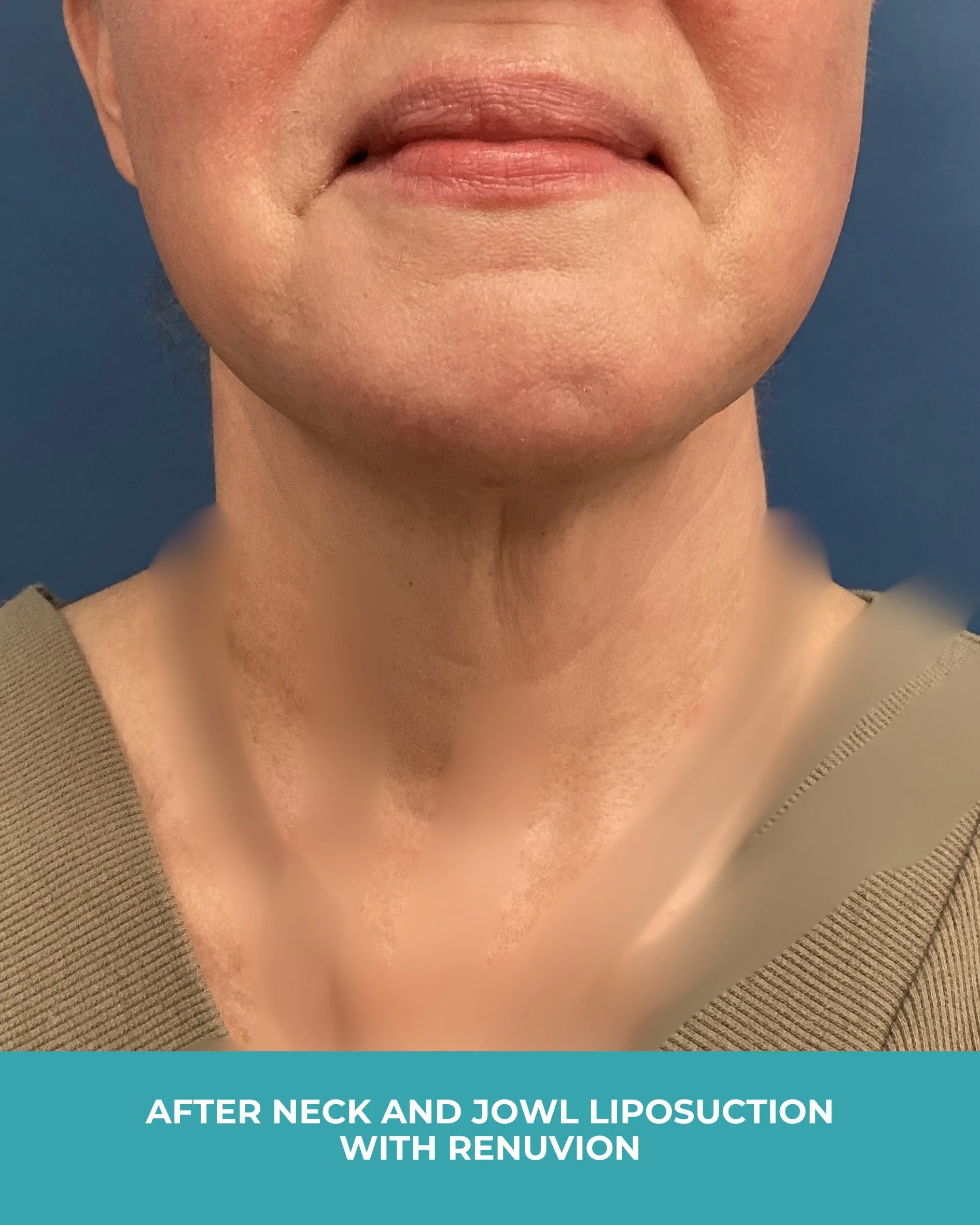 B&A neck and jowl liposuction with renuvion (2).jpg
