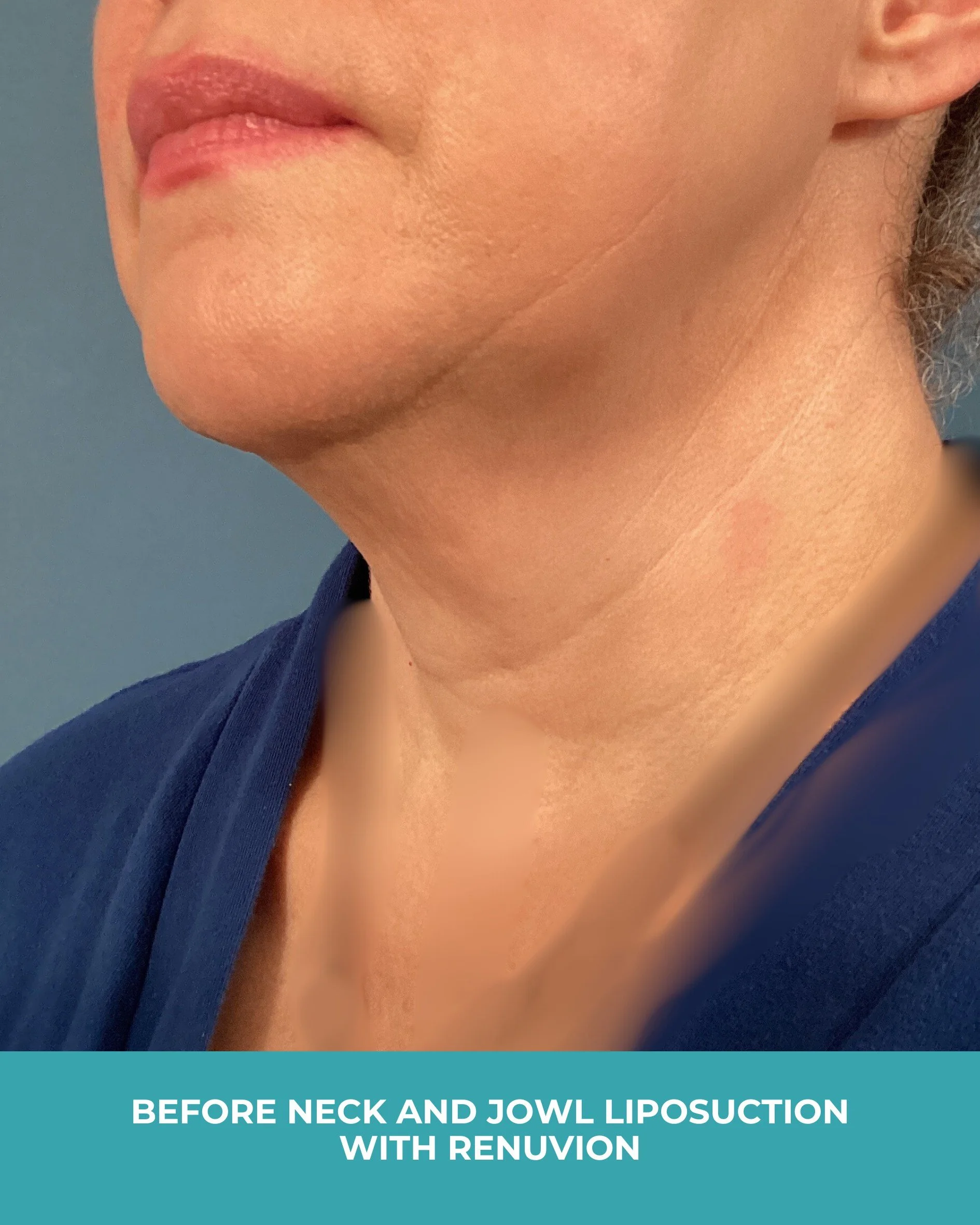 B&A neck and jowl liposuction with renuvion (3).jpg