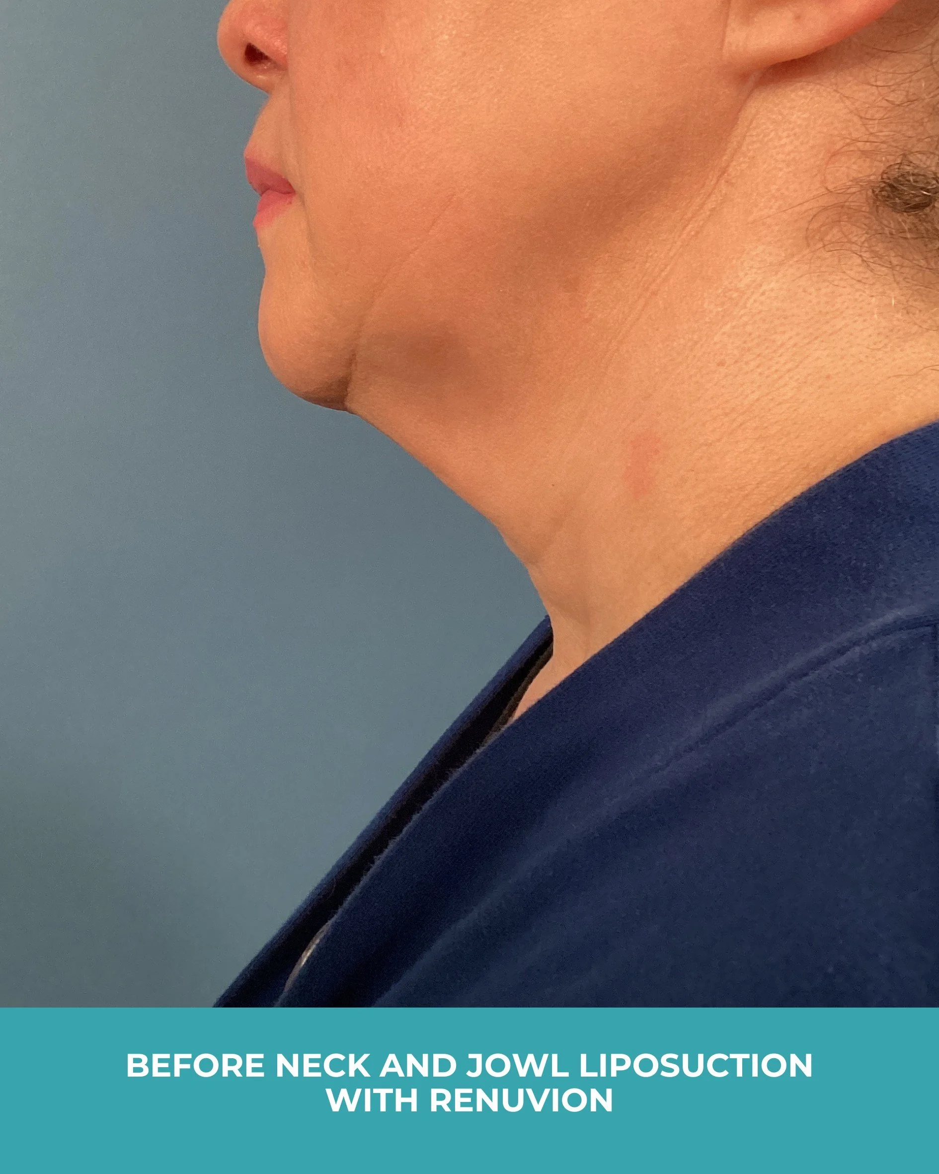 B&A neck and jowl liposuction with renuvion (5).jpg