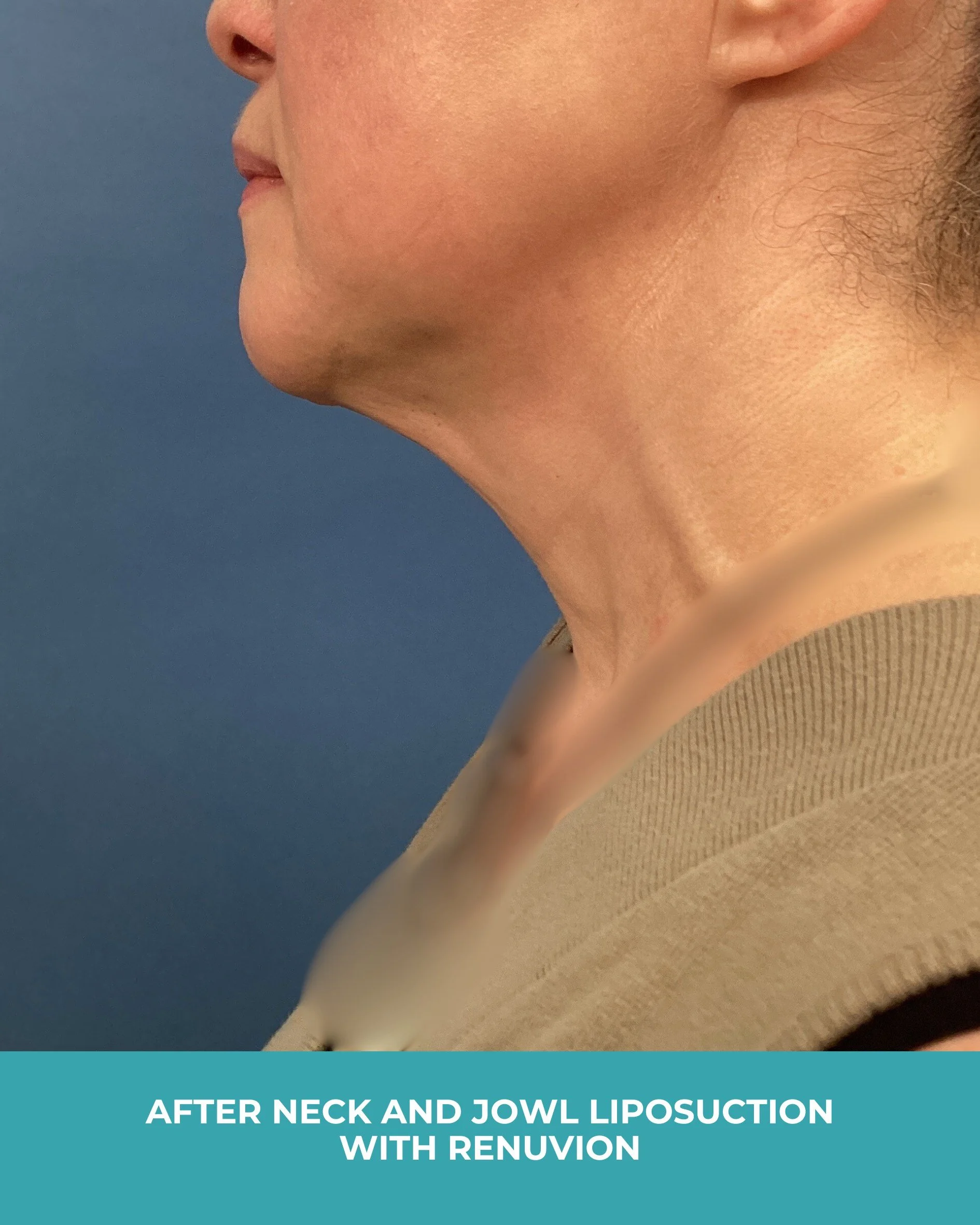 B&A neck and jowl liposuction with renuvion (6).jpg