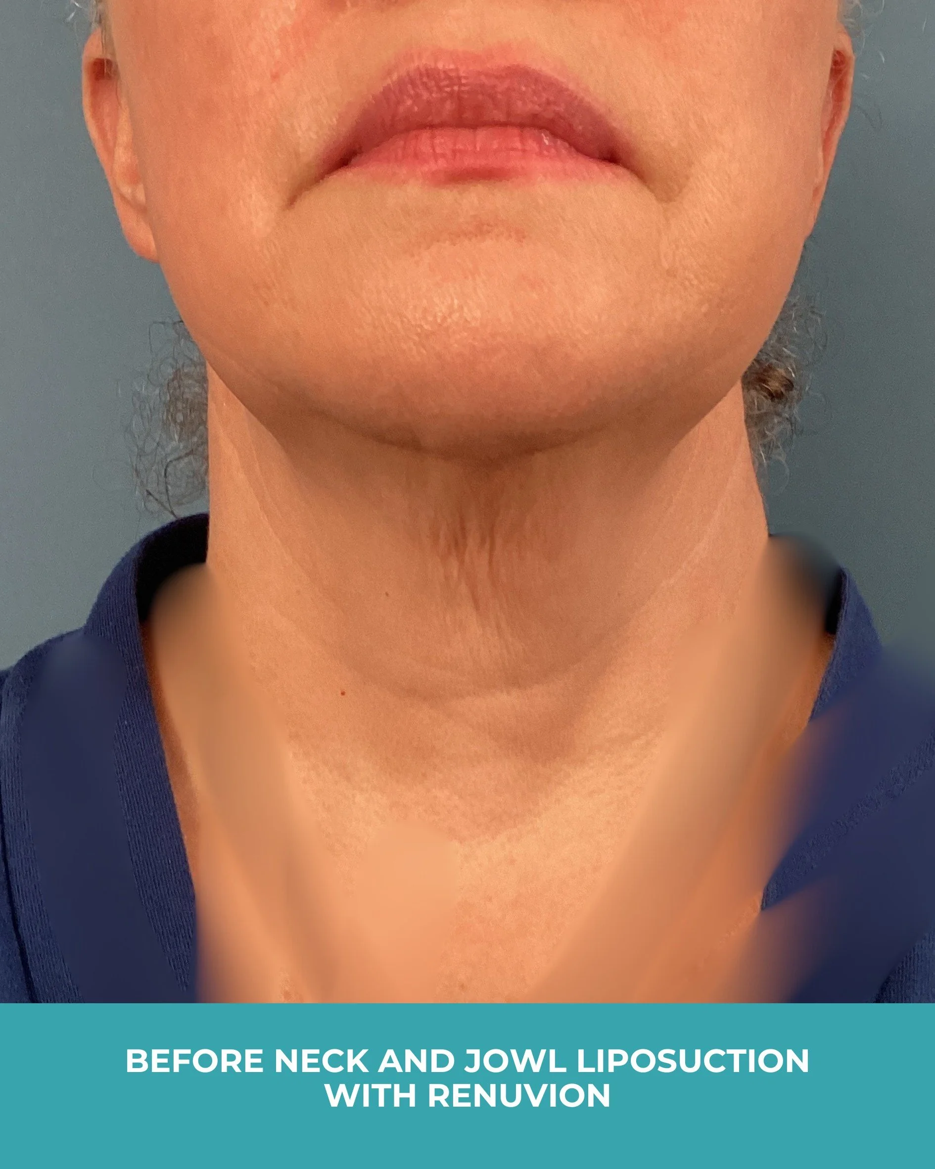 B&A neck and jowl liposuction with renuvion.jpg