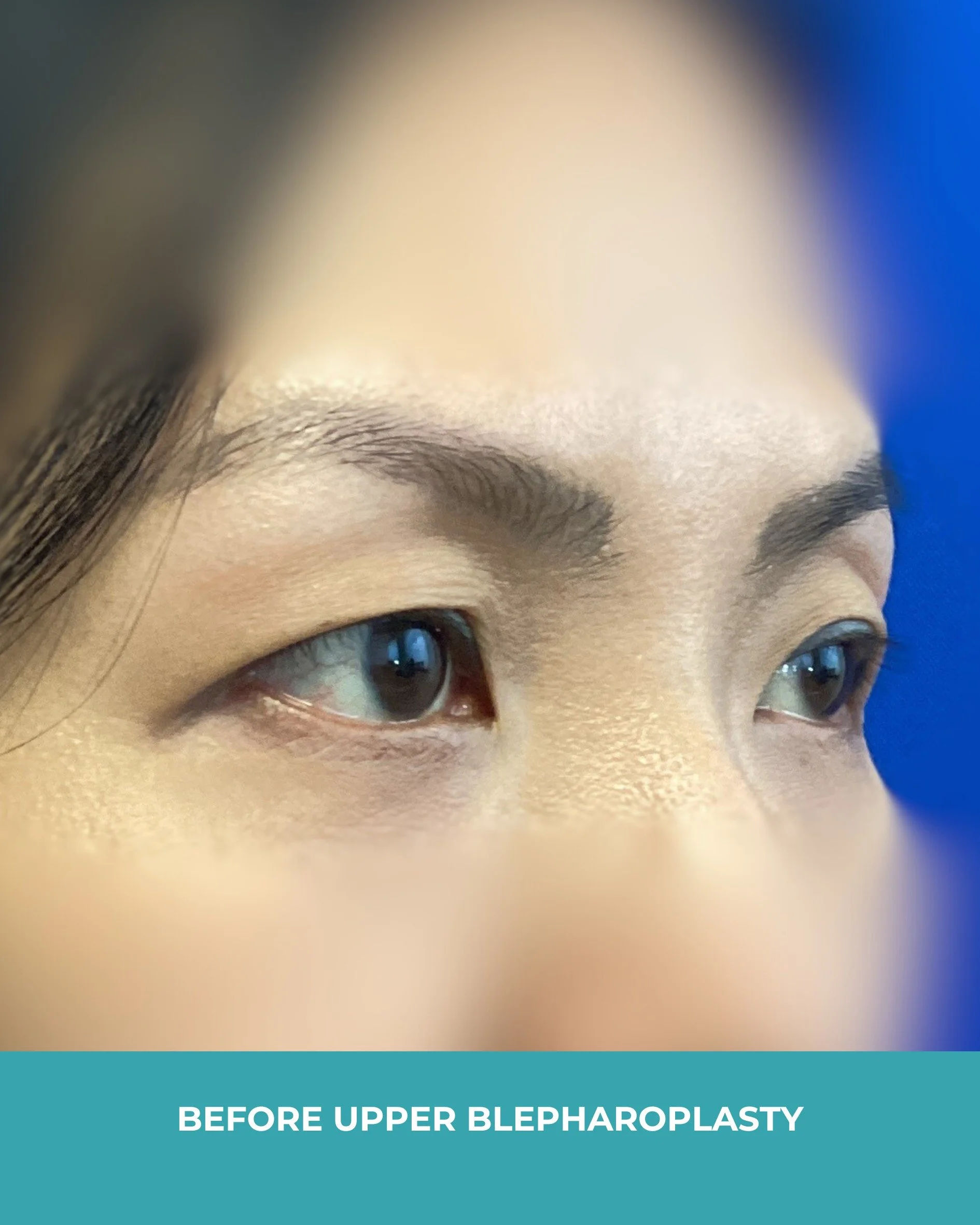 B&A upper blepharoplasty (3).jpg