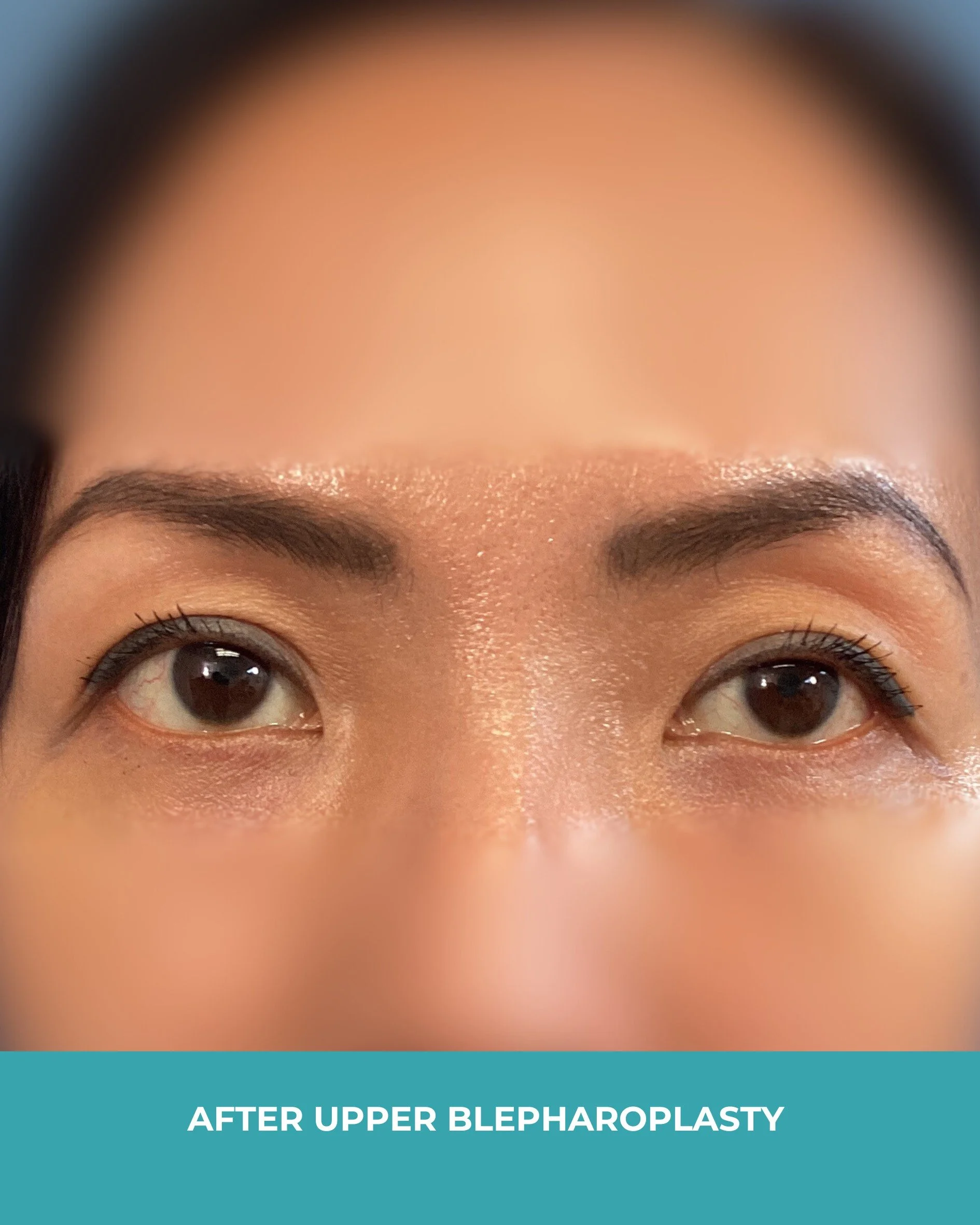 B&A upper blepharoplasty (2).jpg