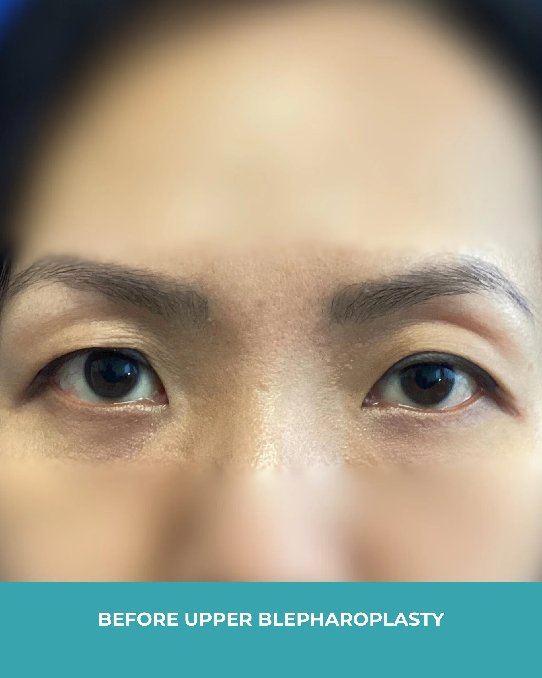 B&A upper blepharoplasty.jpg