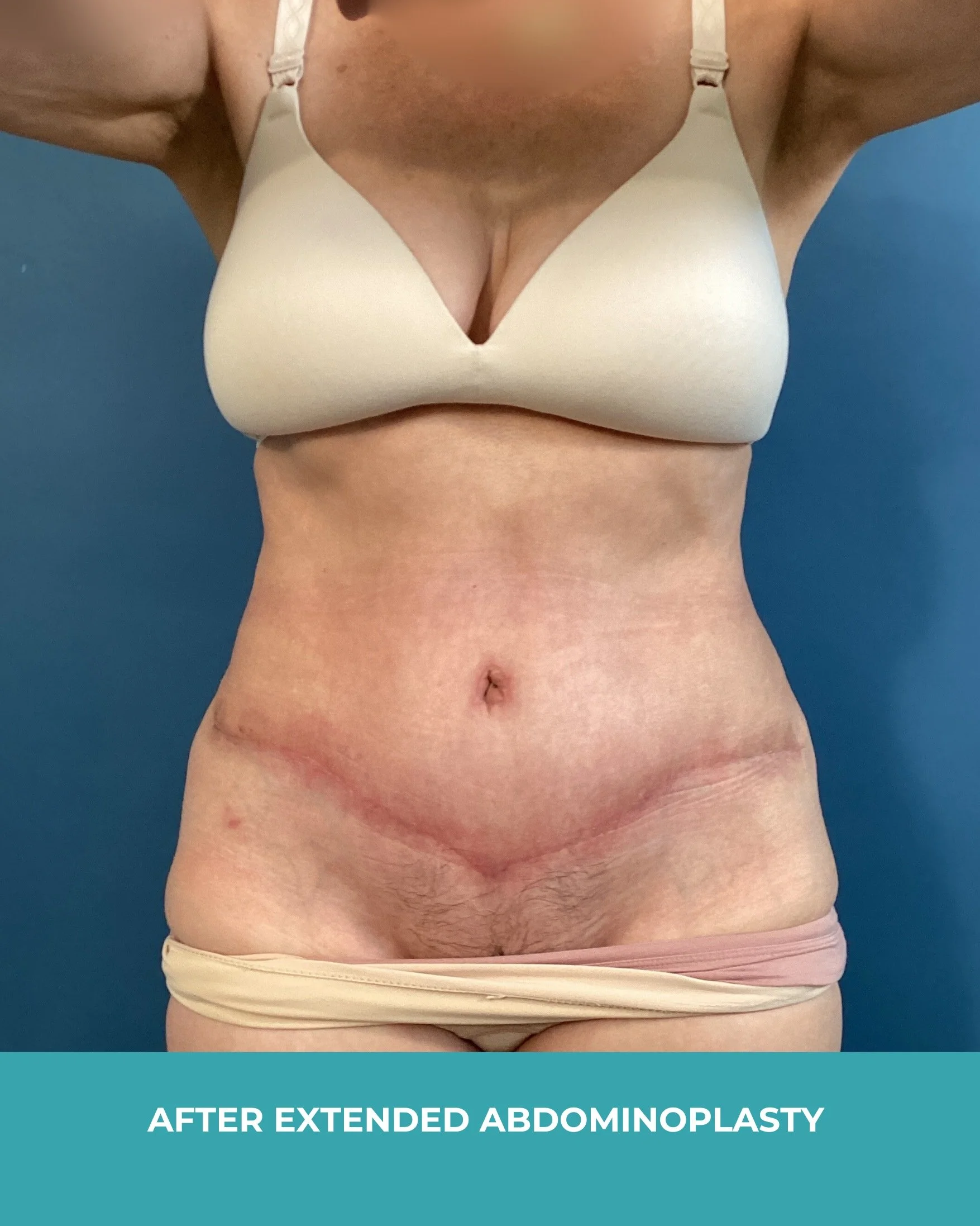 B&A extended abdominoplasty (2).jpg