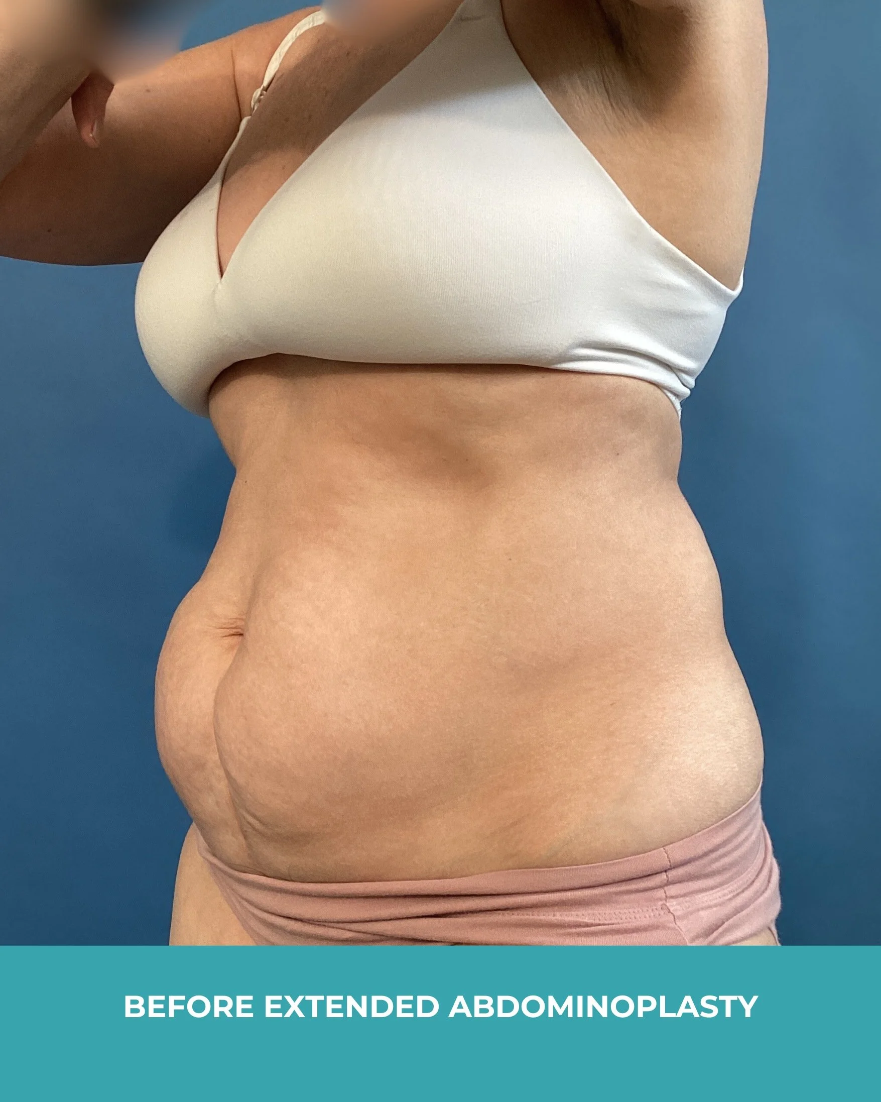 B&A extended abdominoplasty (3).jpg