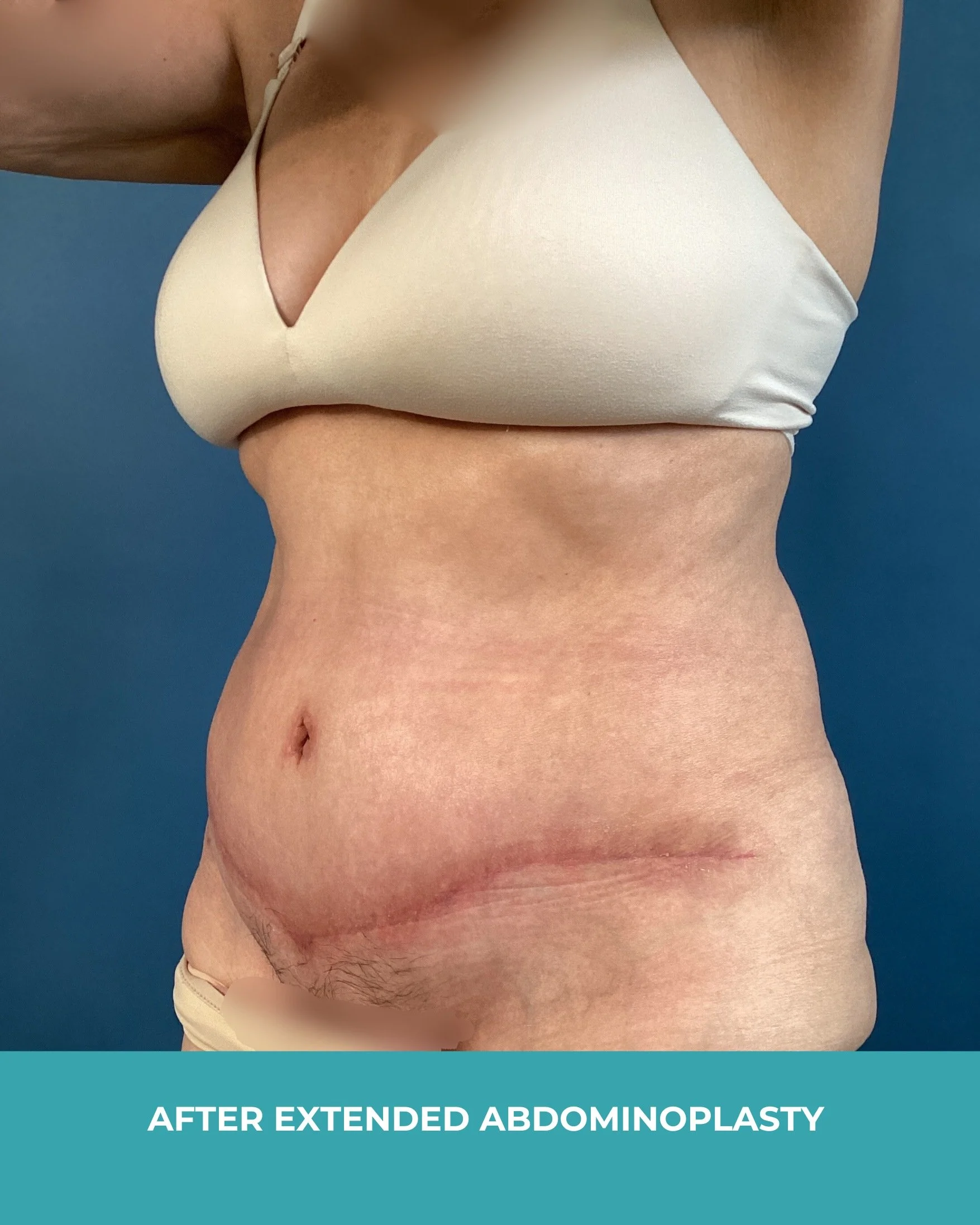 B&A extended abdominoplasty (4).jpg
