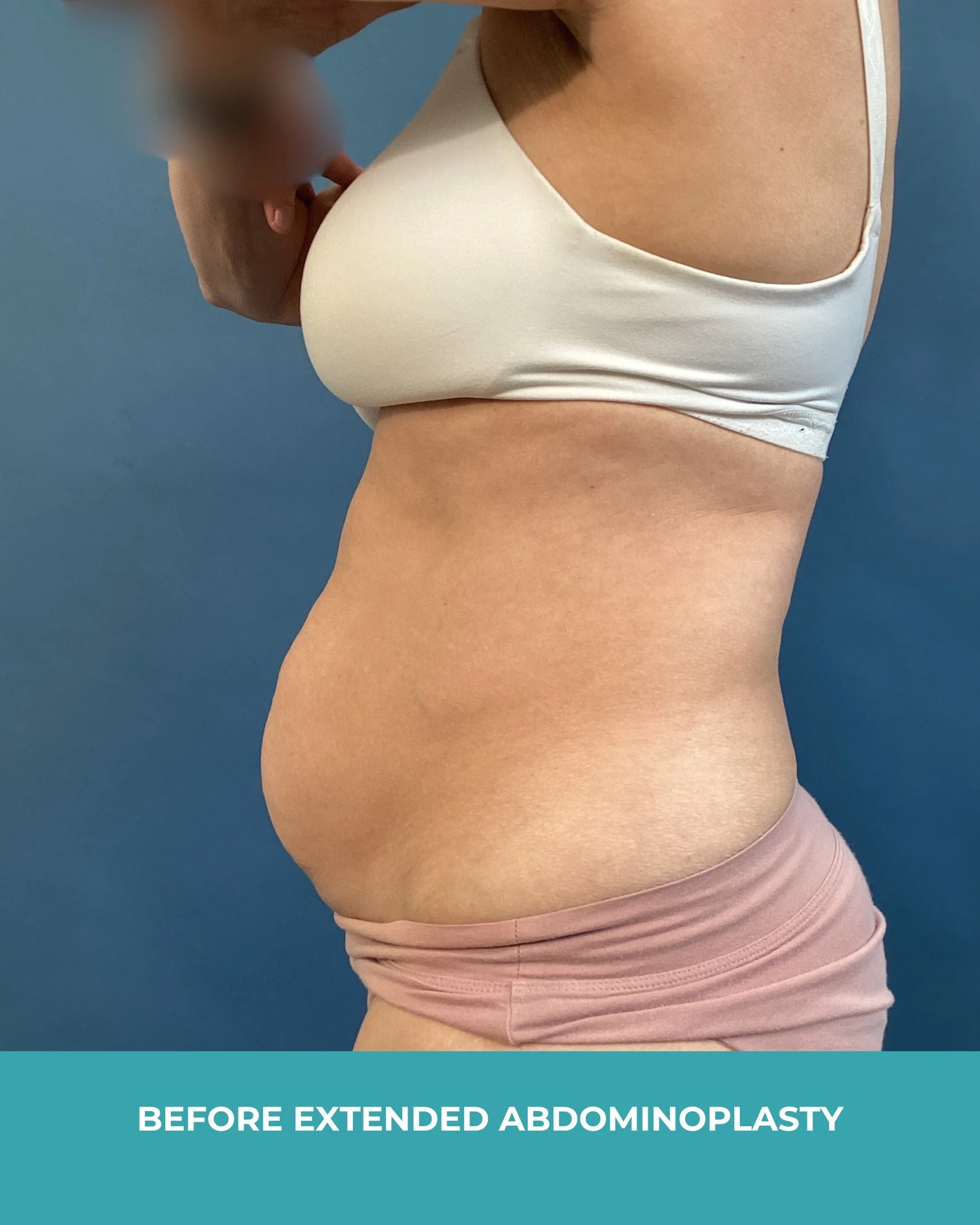 B&A extended abdominoplasty (5).jpg
