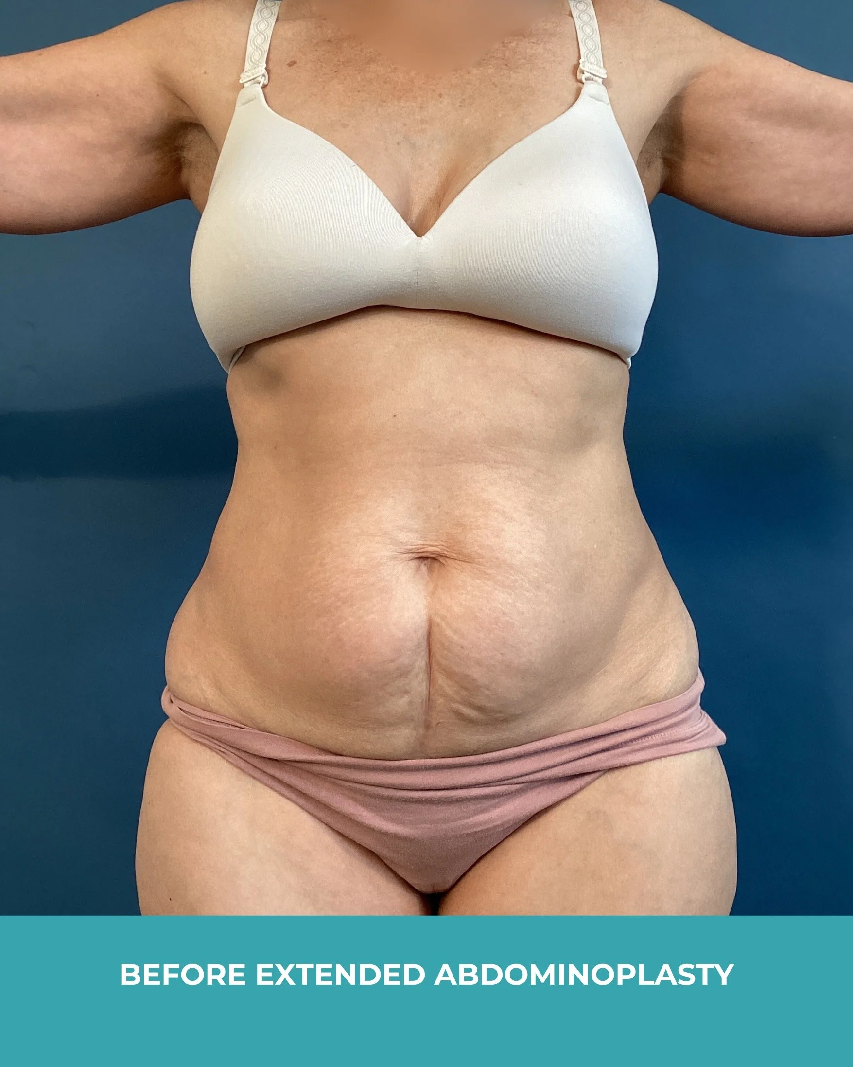 B&A extended abdominoplasty.jpg