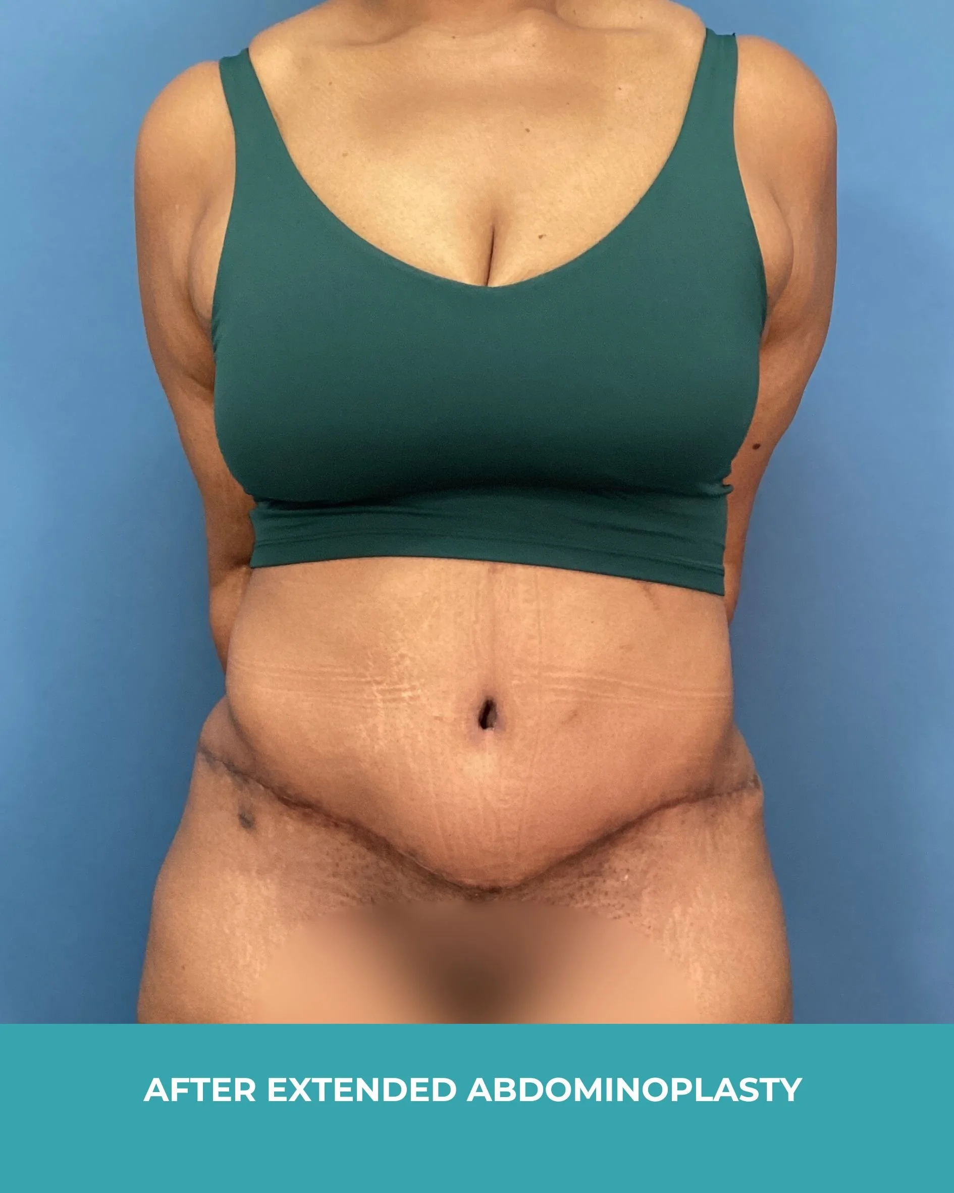 B&A extended abdominoplasty2 (2).jpg