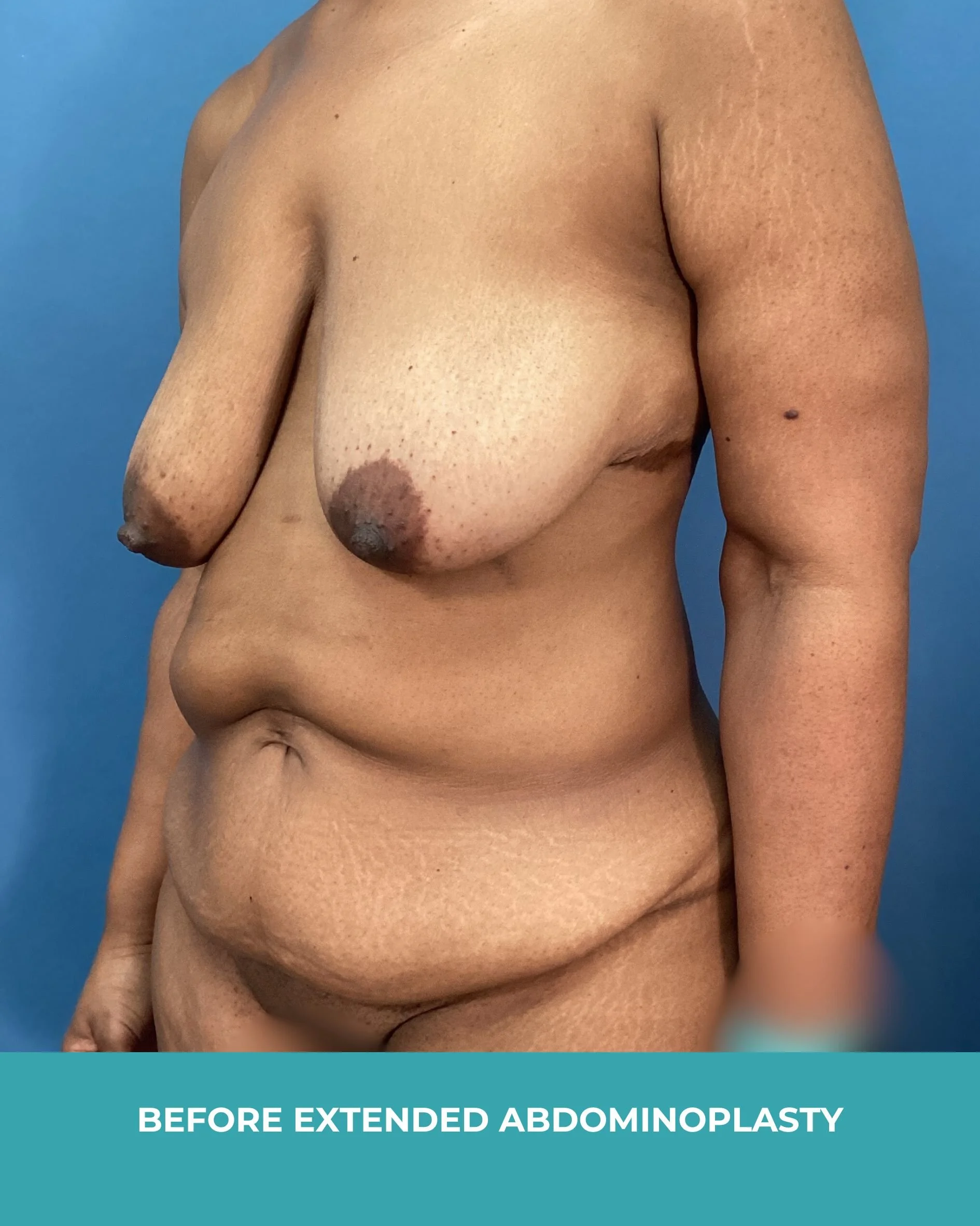 B&A extended abdominoplasty2 (3).jpg